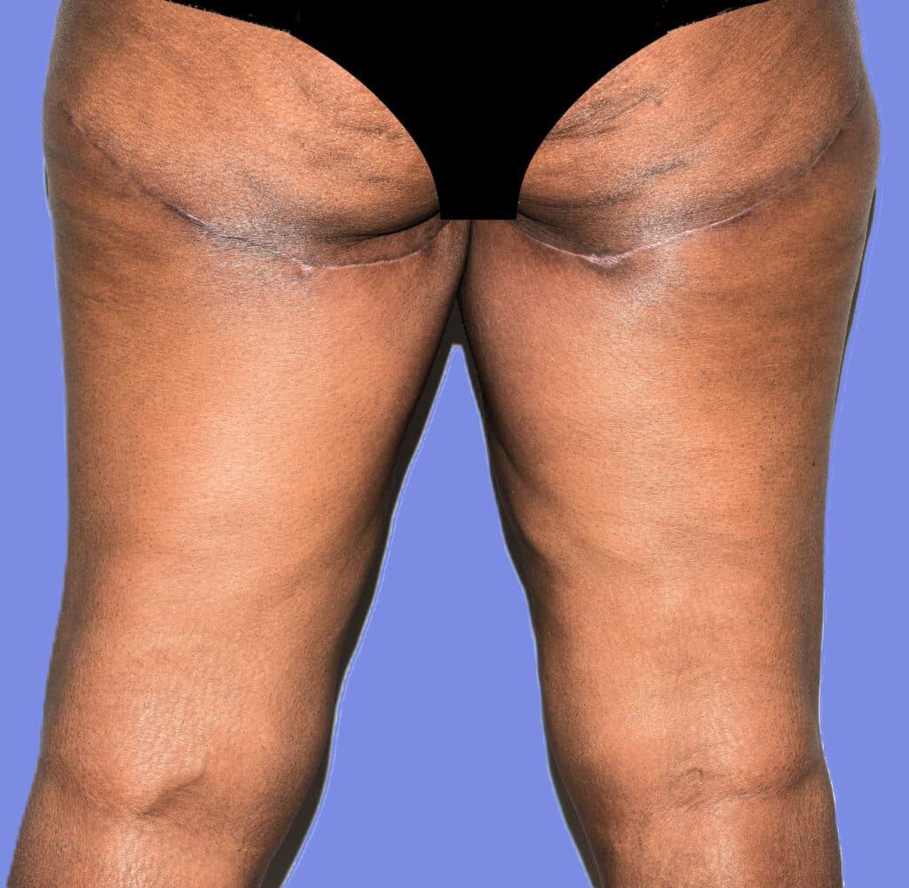 After Image: Thigh Lift - back