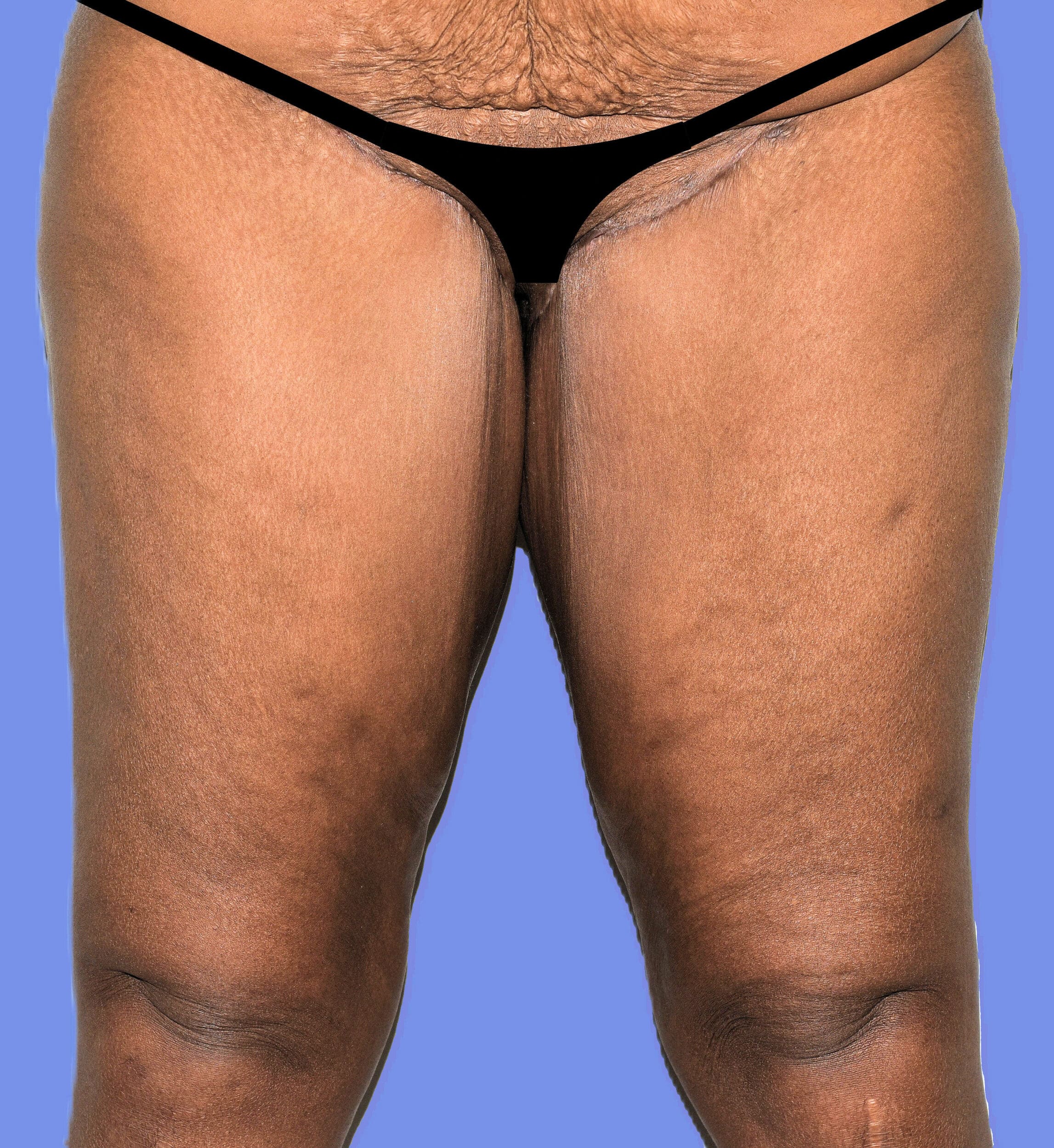 After Image: Thigh Lift - front