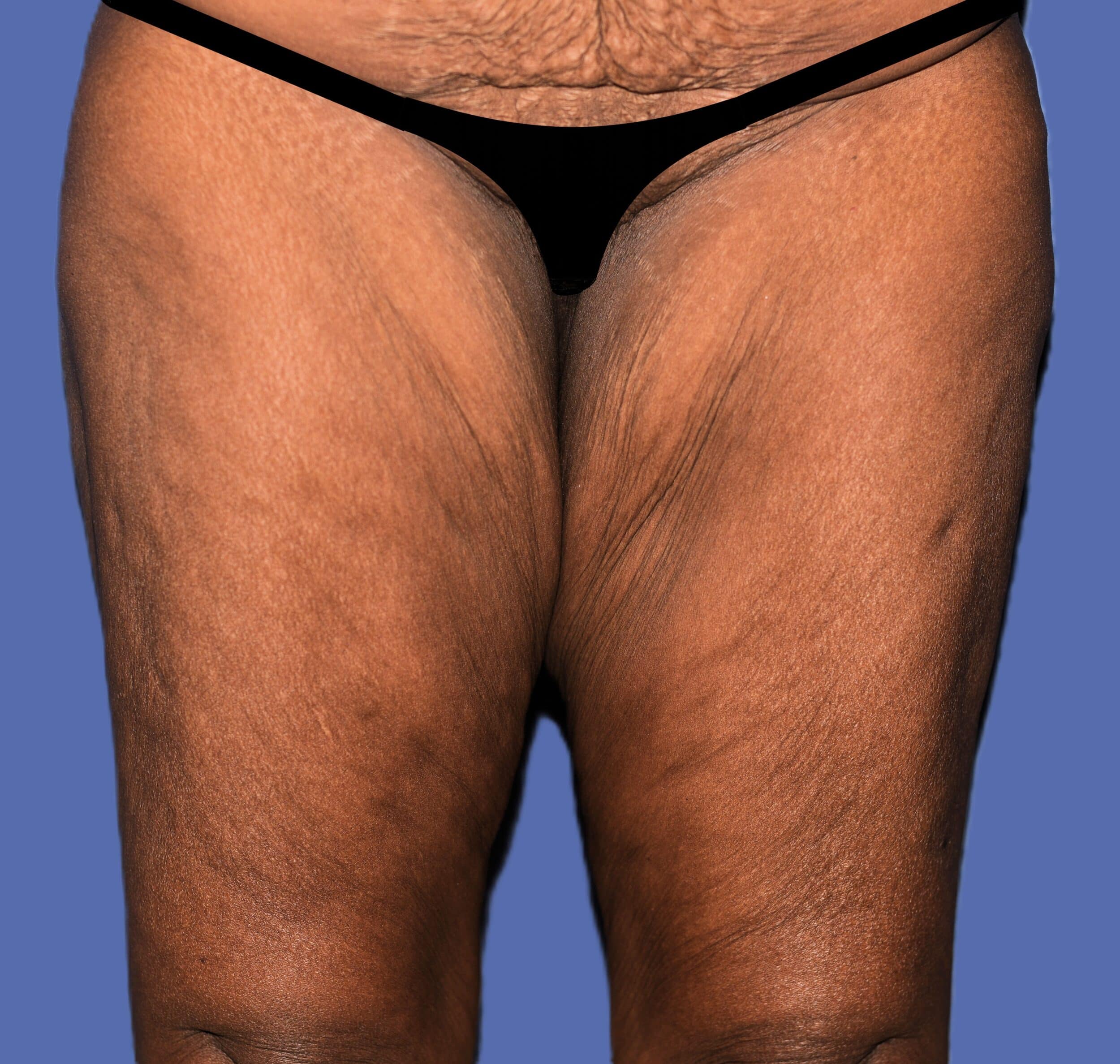 Before Image: Thigh Lift - front