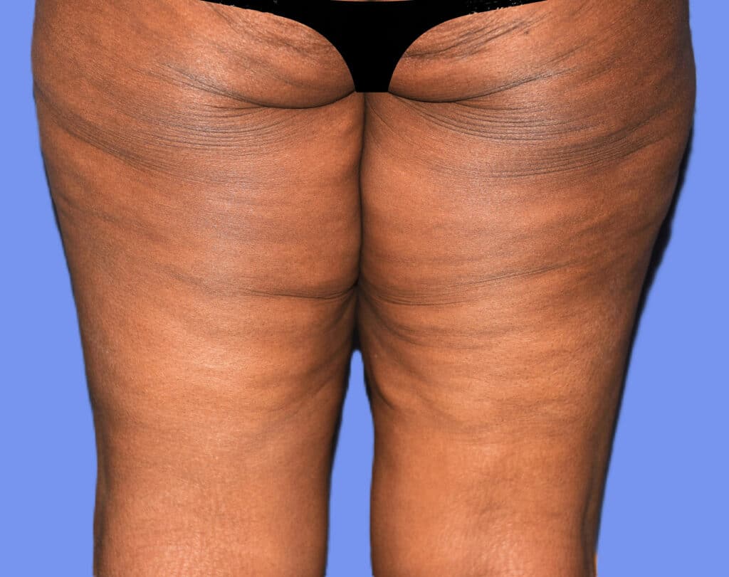 Before Image: Thigh Lift - back