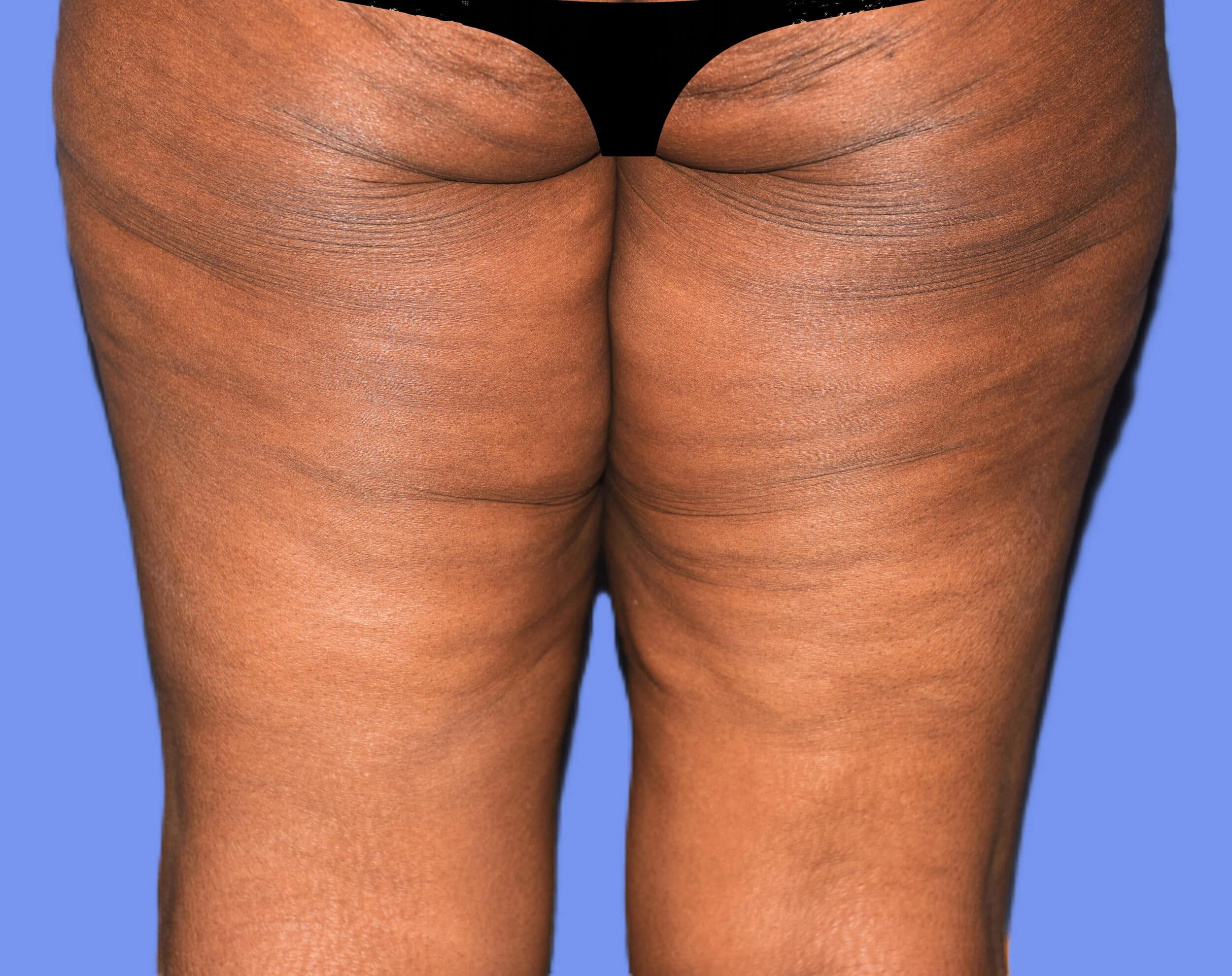 Before Image: Thigh Lift - back