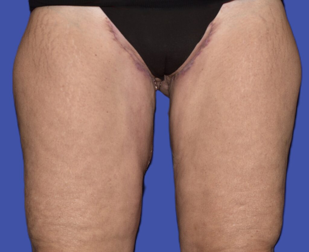 After Image: Thigh Lift - front