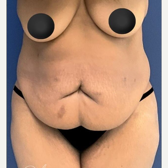 Before Image: Tummy Tuck - front