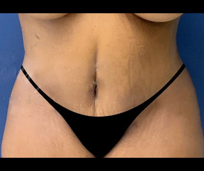 After Image: Tummy Tuck - front