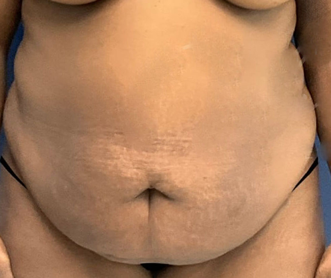 Before Image: Tummy Tuck - front