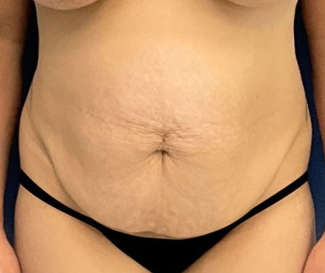 Before Image: Tummy Tuck - front