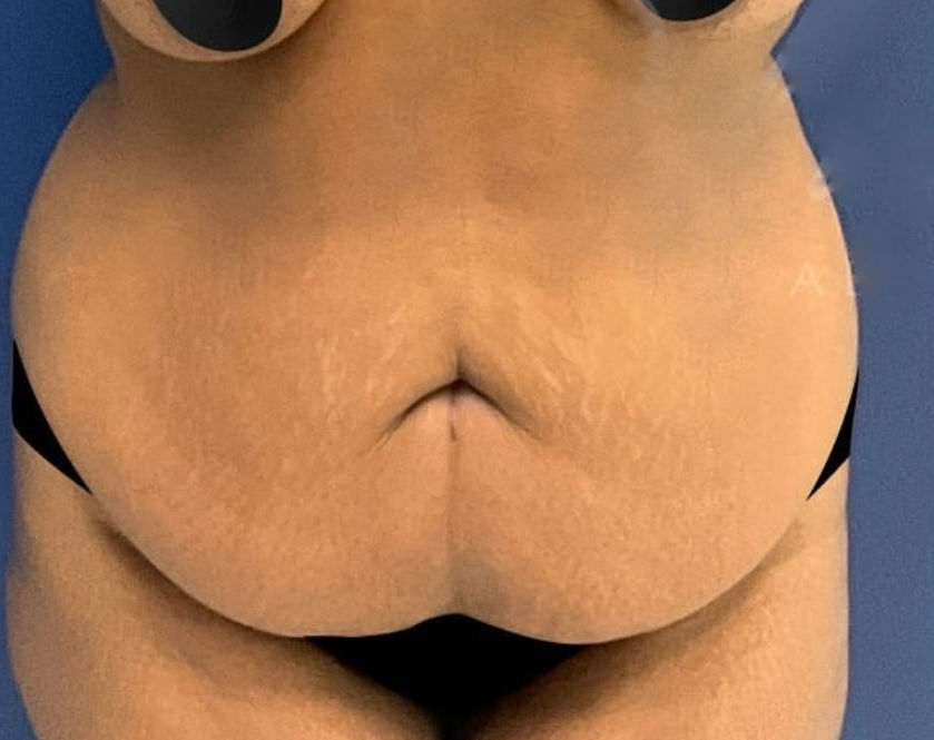 Before Image: Tummy Tuck - front