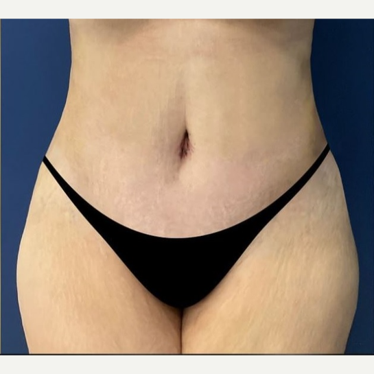 After Image: Tummy Tuck - front