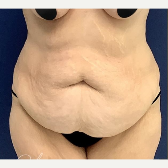 Before Image: Tummy Tuck - front