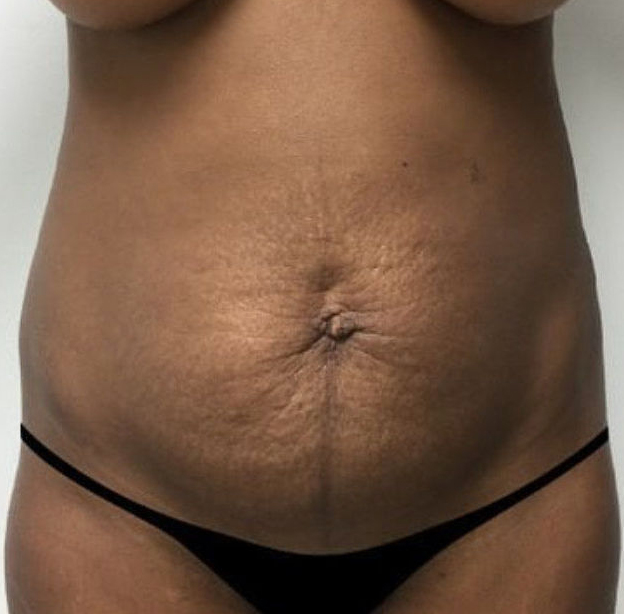 Before Image: Tummy Tuck - front