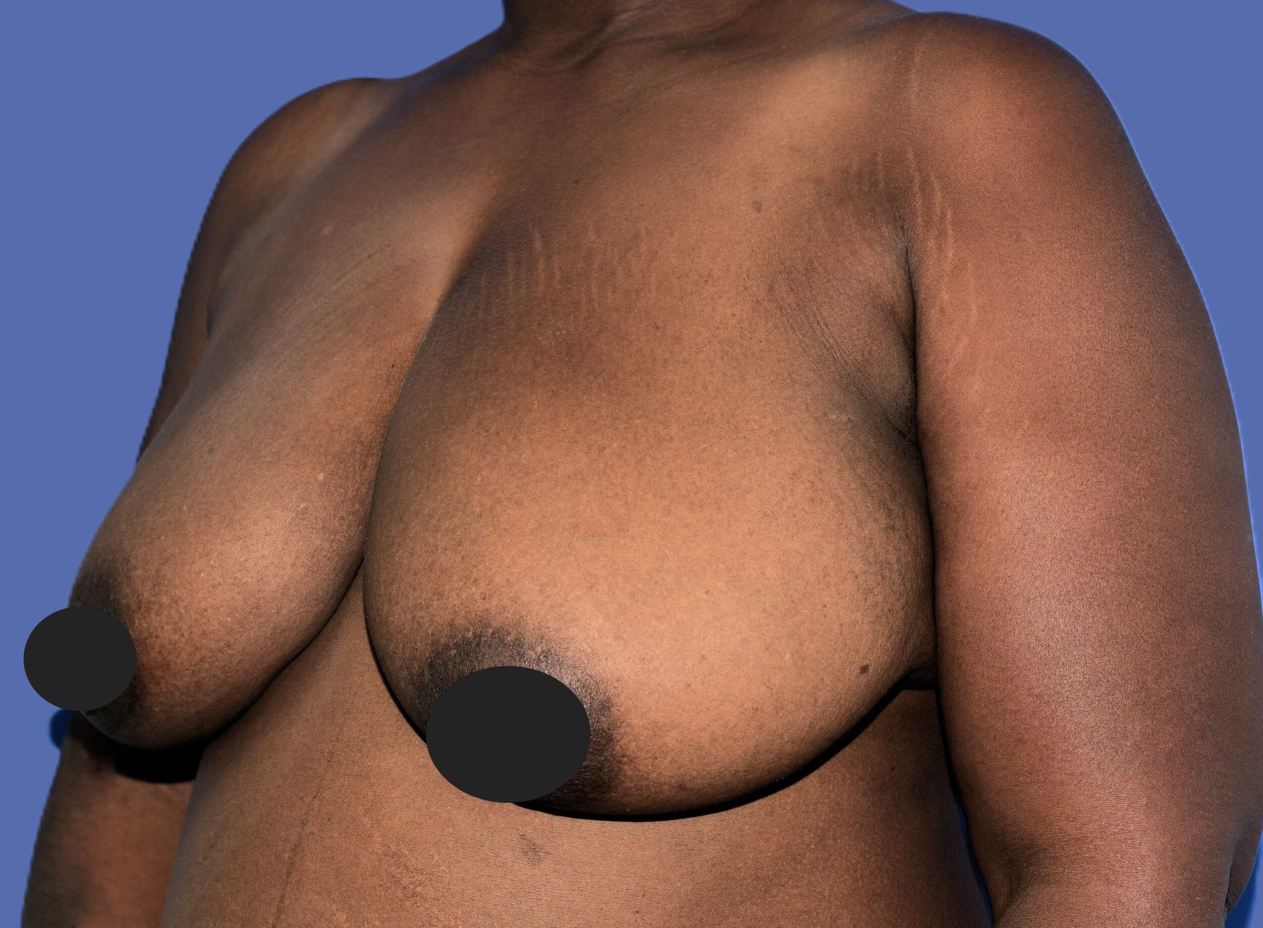 Before Image: Breast Lift (Mastopexy) - left-front-oblique