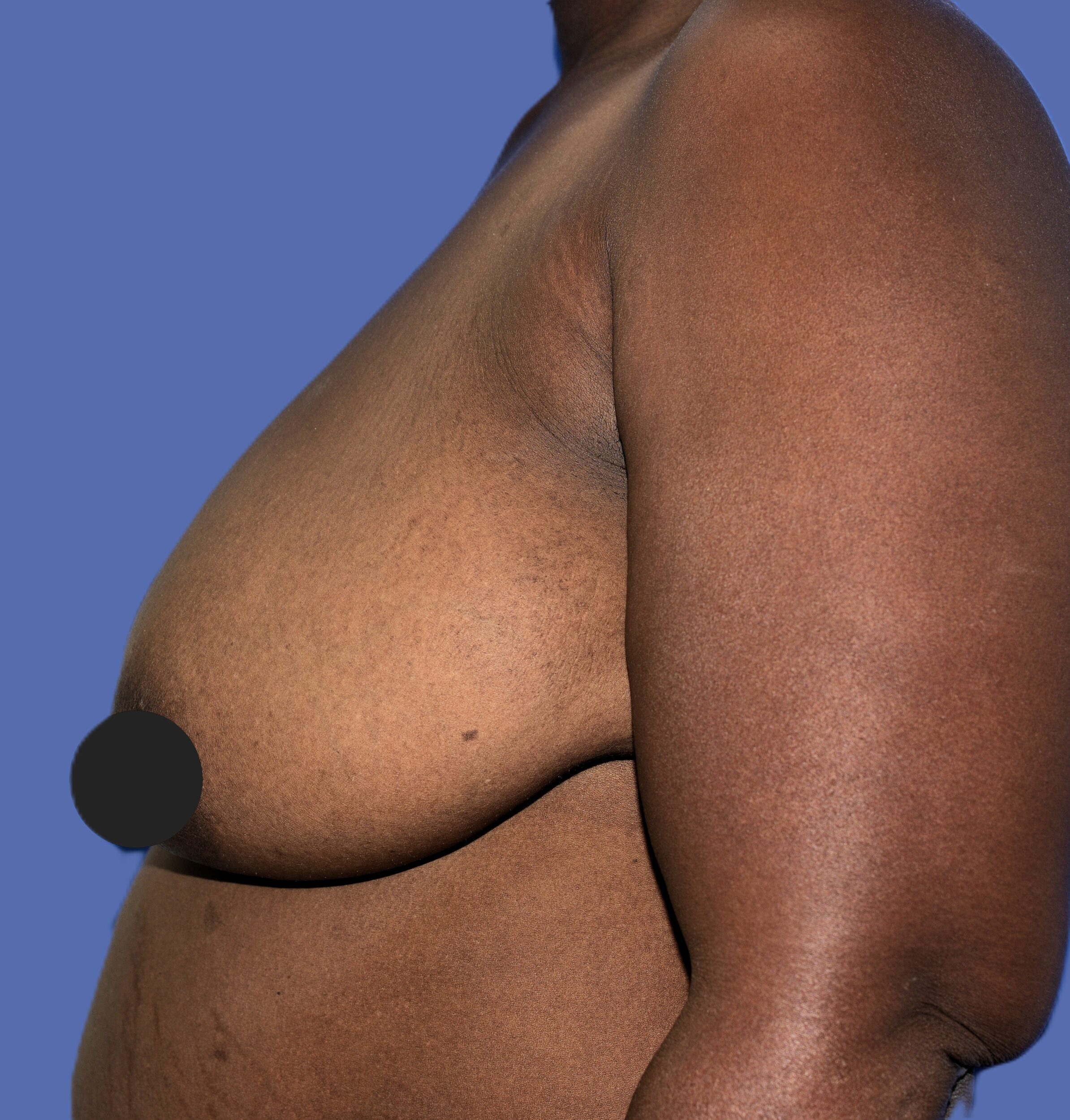 Before Image: Breast Lift (Mastopexy) - left-side
