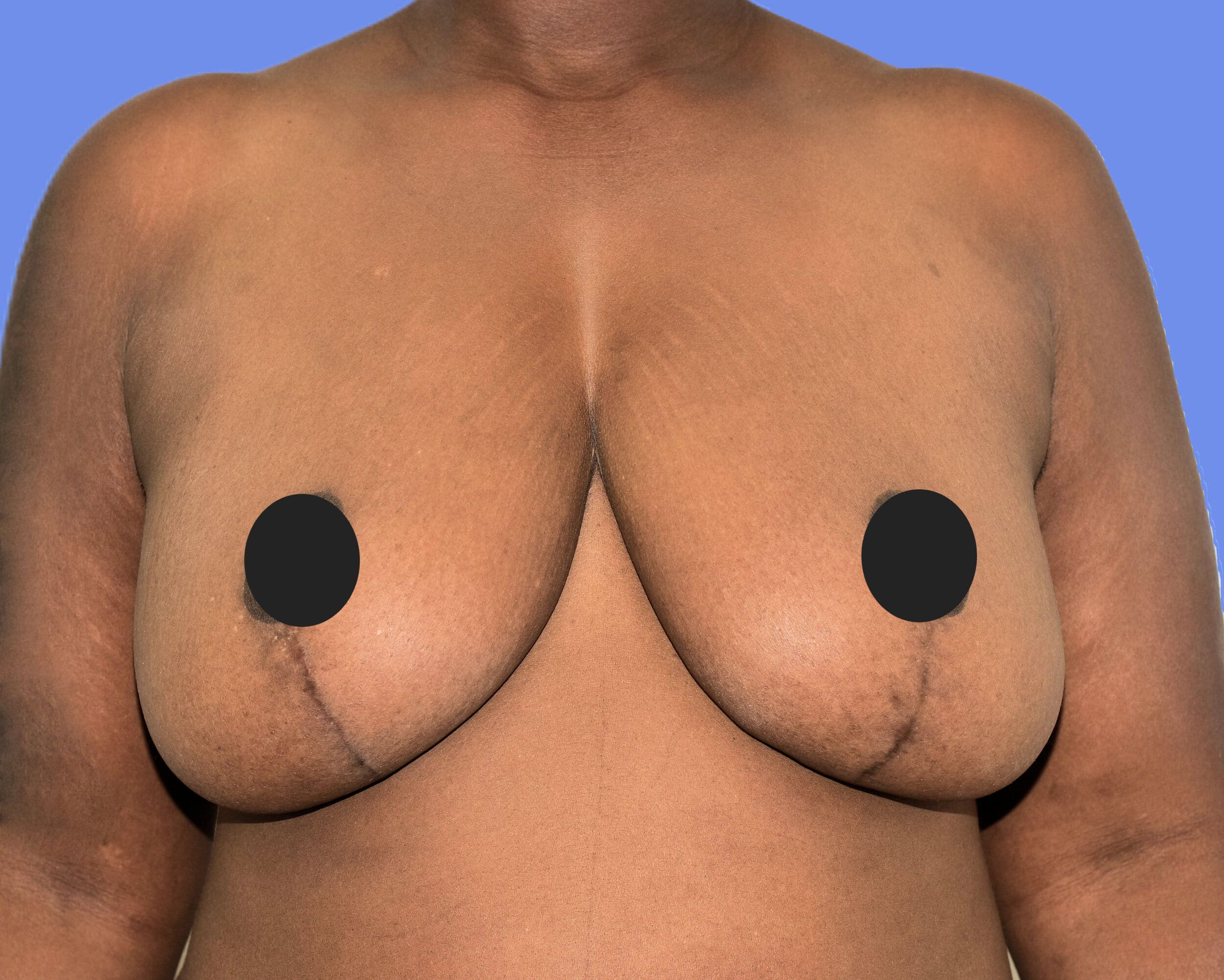 After Image: Breast Lift (Mastopexy) - front