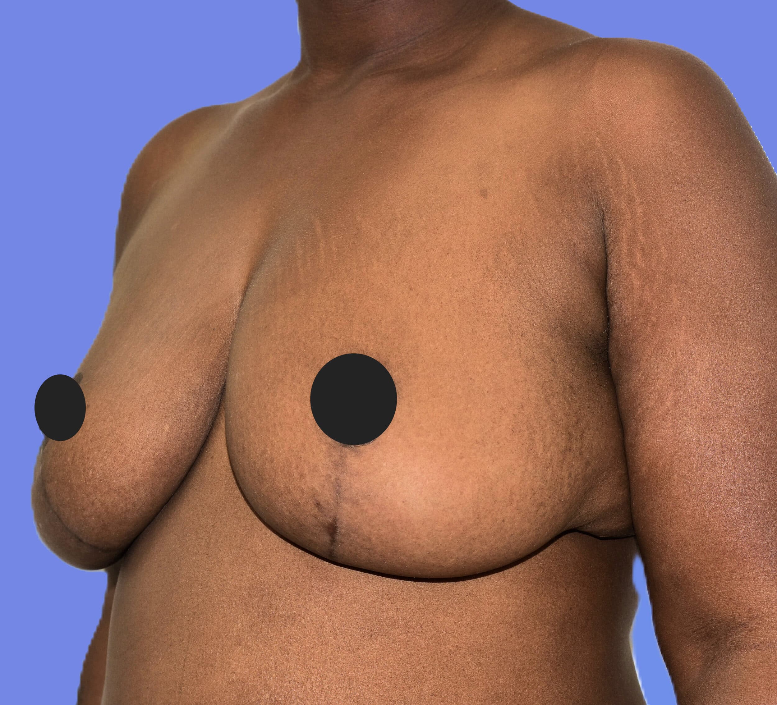 After Image: Breast Lift (Mastopexy) - left-front-oblique