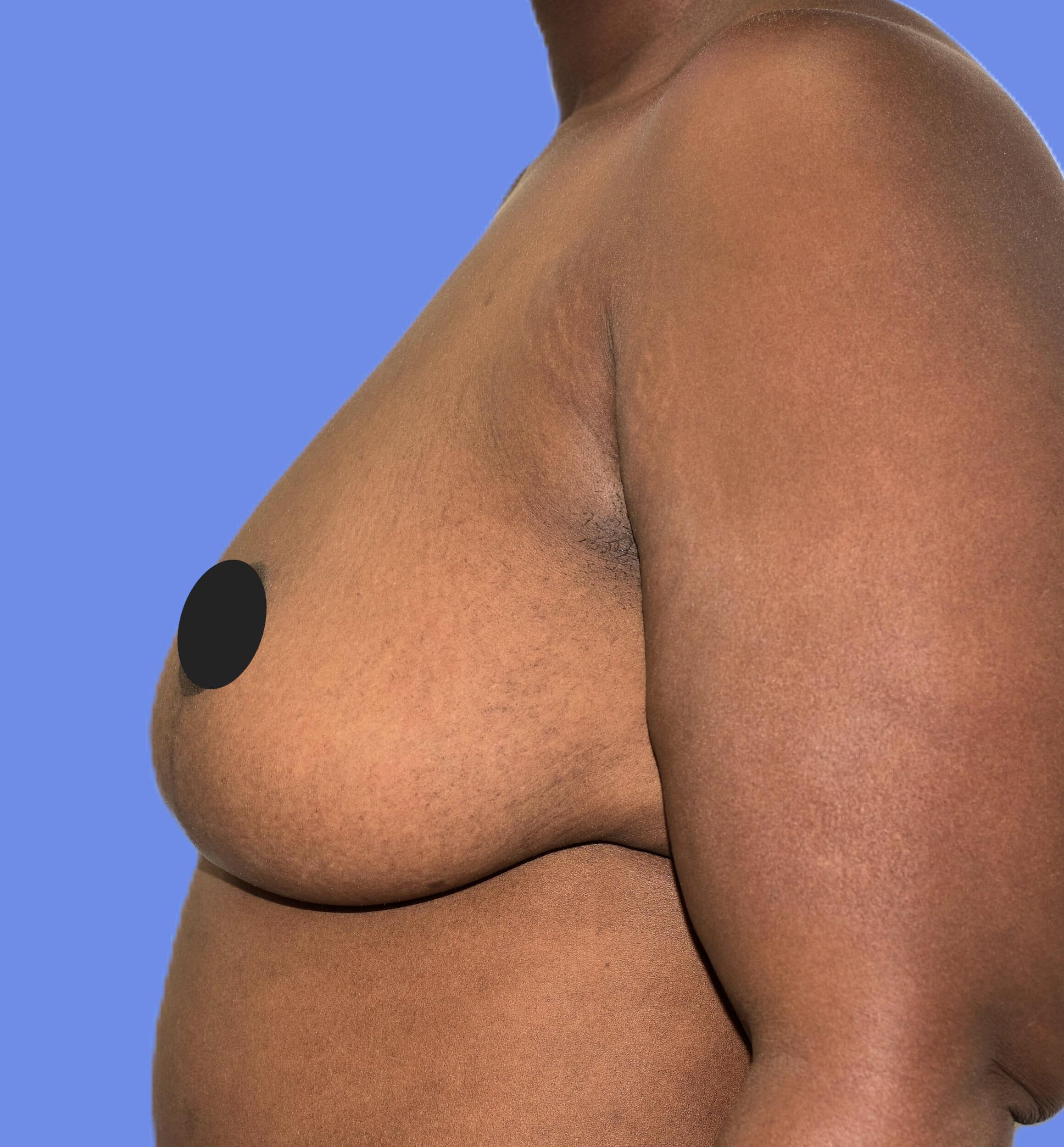 After Image: Breast Lift (Mastopexy) - left-side
