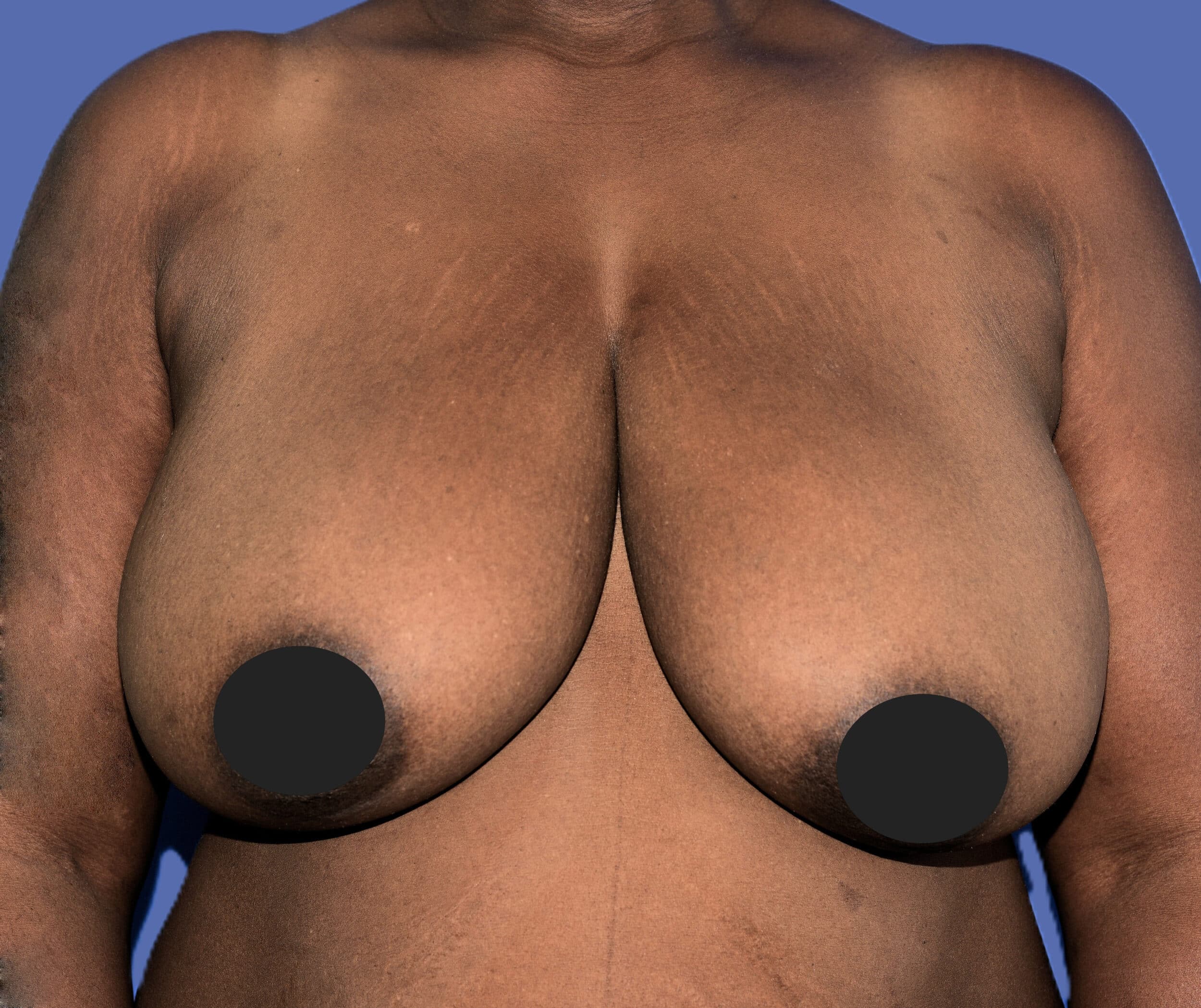 Before Image: Breast Lift (Mastopexy) - front