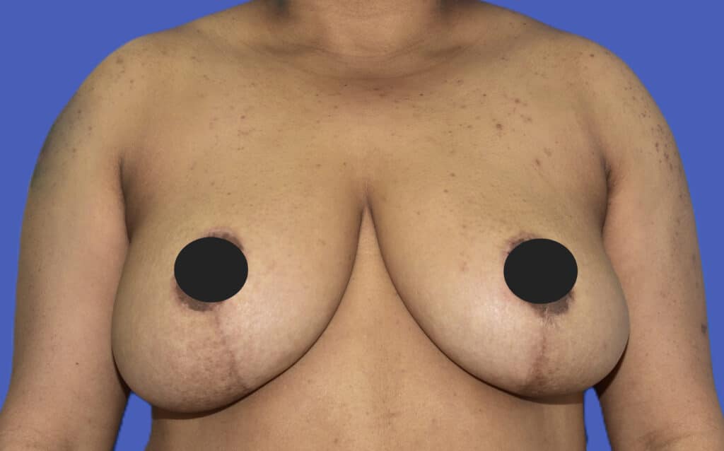 After Image: Breast Lift (Mastopexy) - front