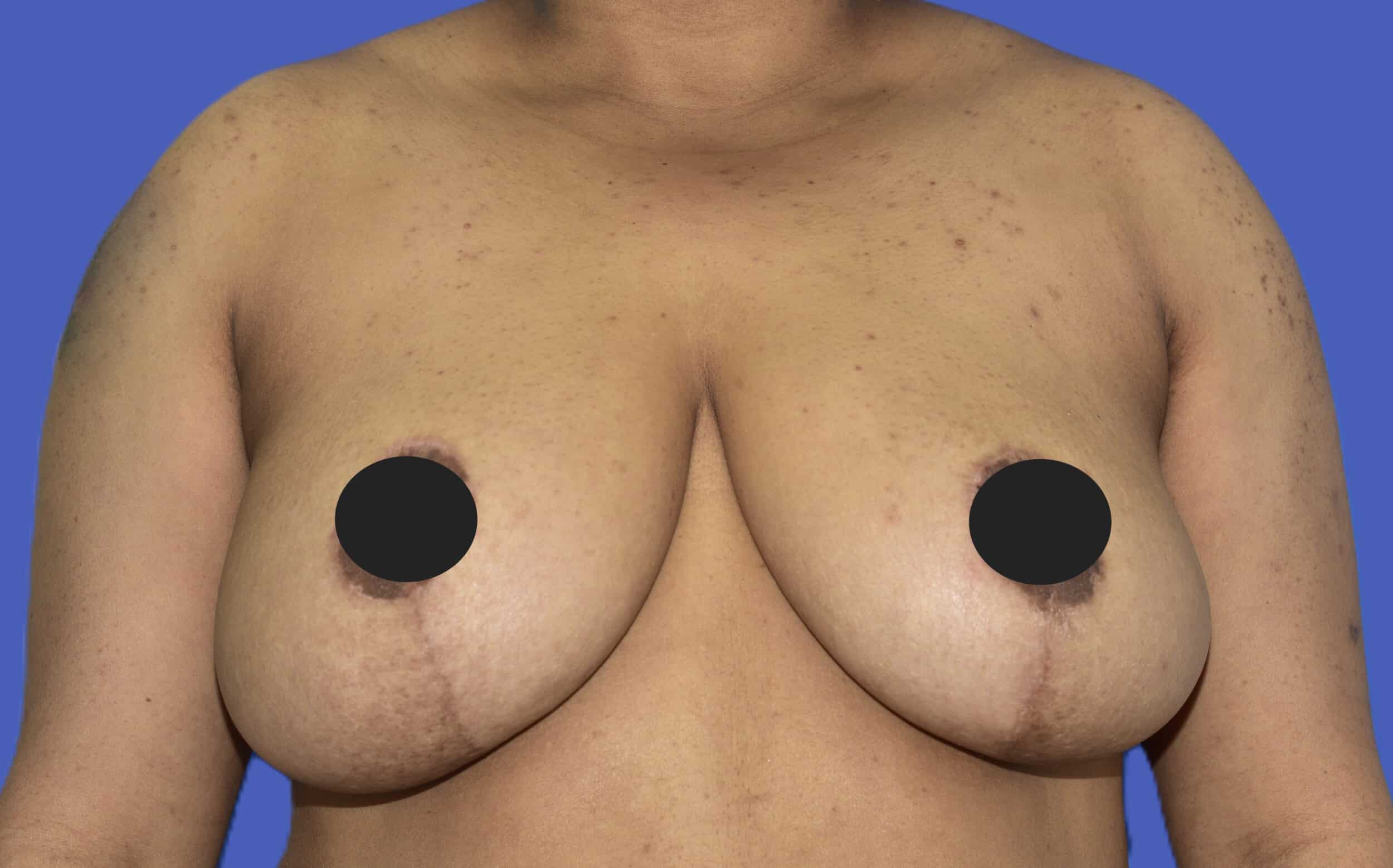 After Image: Breast Lift (Mastopexy) - front