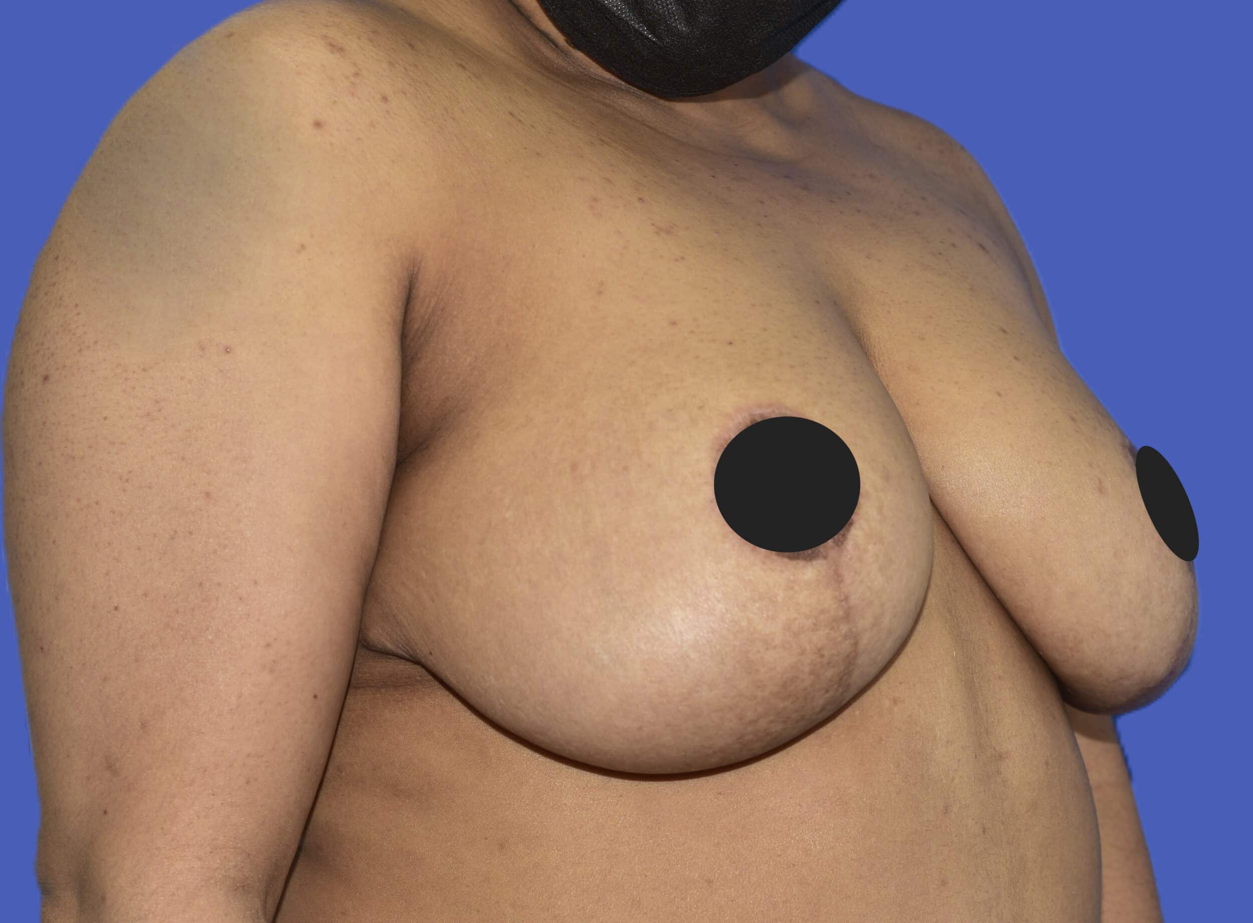After Image: Breast Lift (Mastopexy) - right-front-oblique