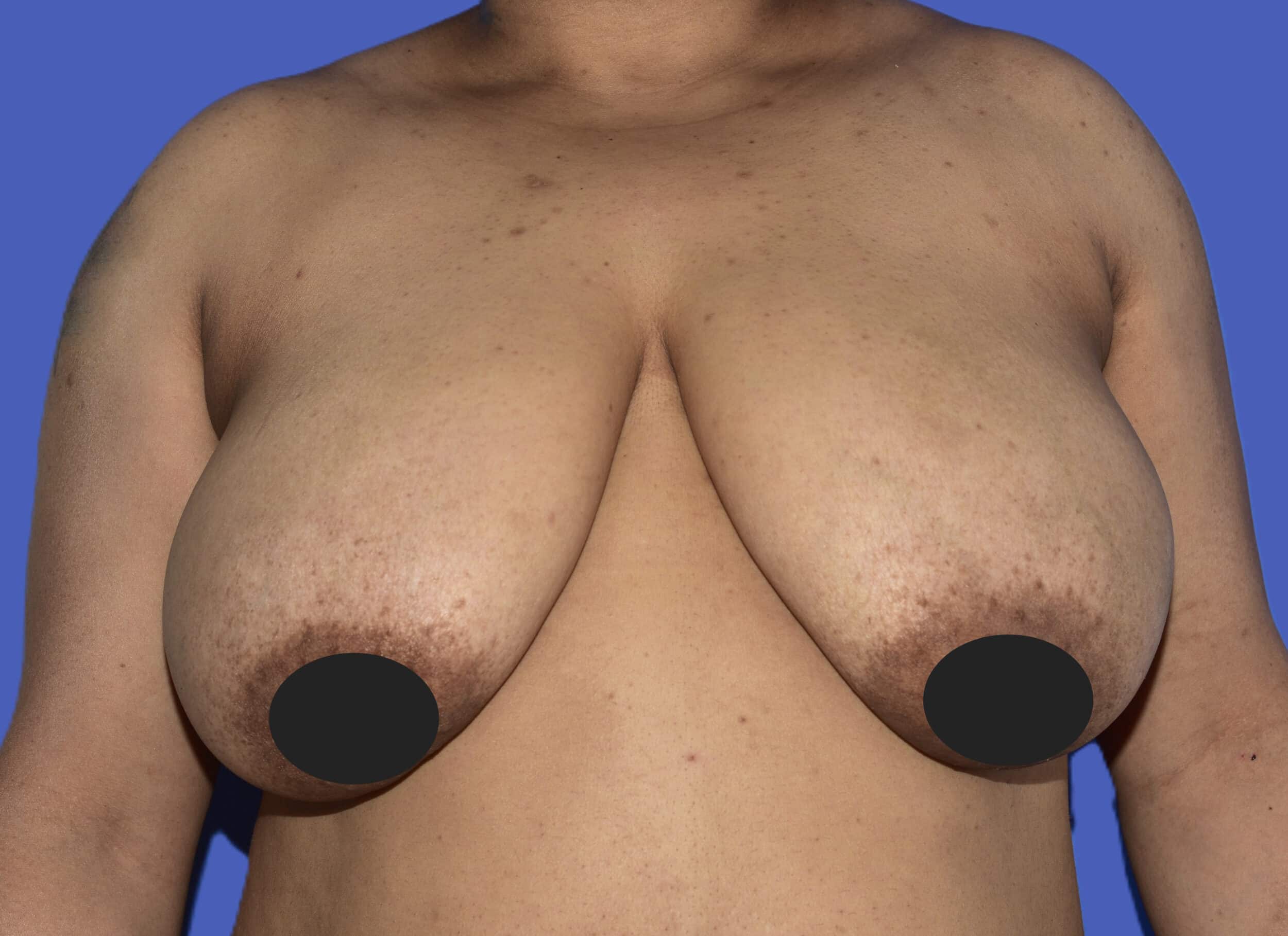 Before Image: Breast Lift (Mastopexy) - front