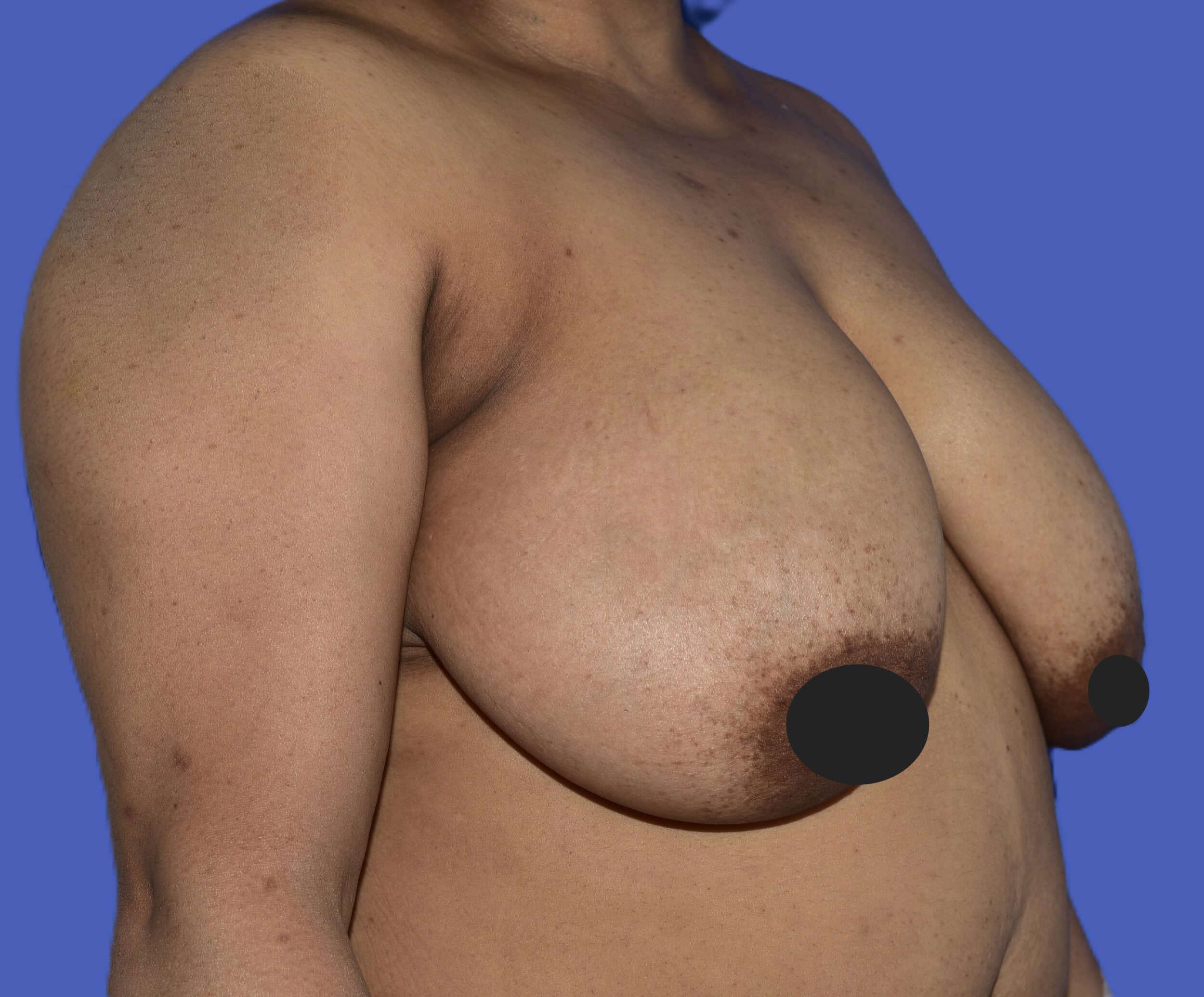 Before Image: Breast Lift (Mastopexy) - right-front-oblique