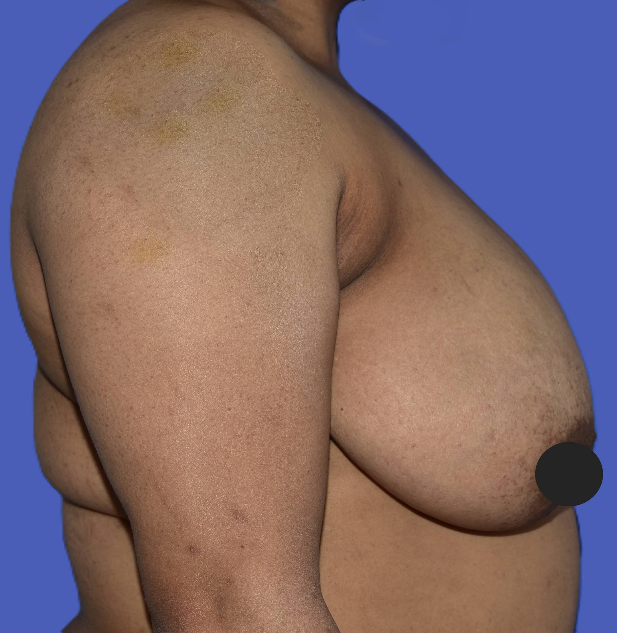 Before Image: Breast Lift (Mastopexy) - right-side