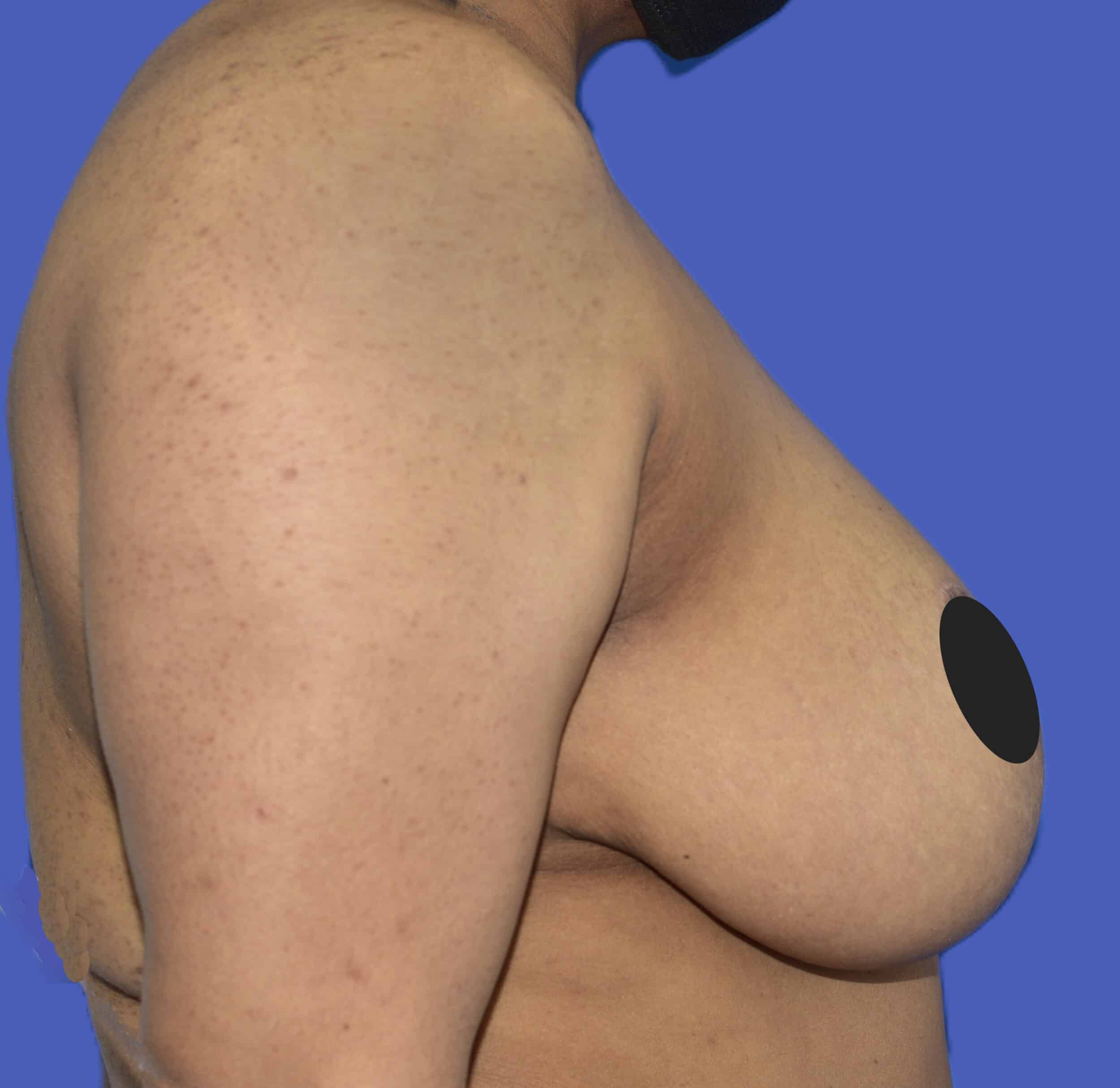 After Image: Breast Lift (Mastopexy) - right-side