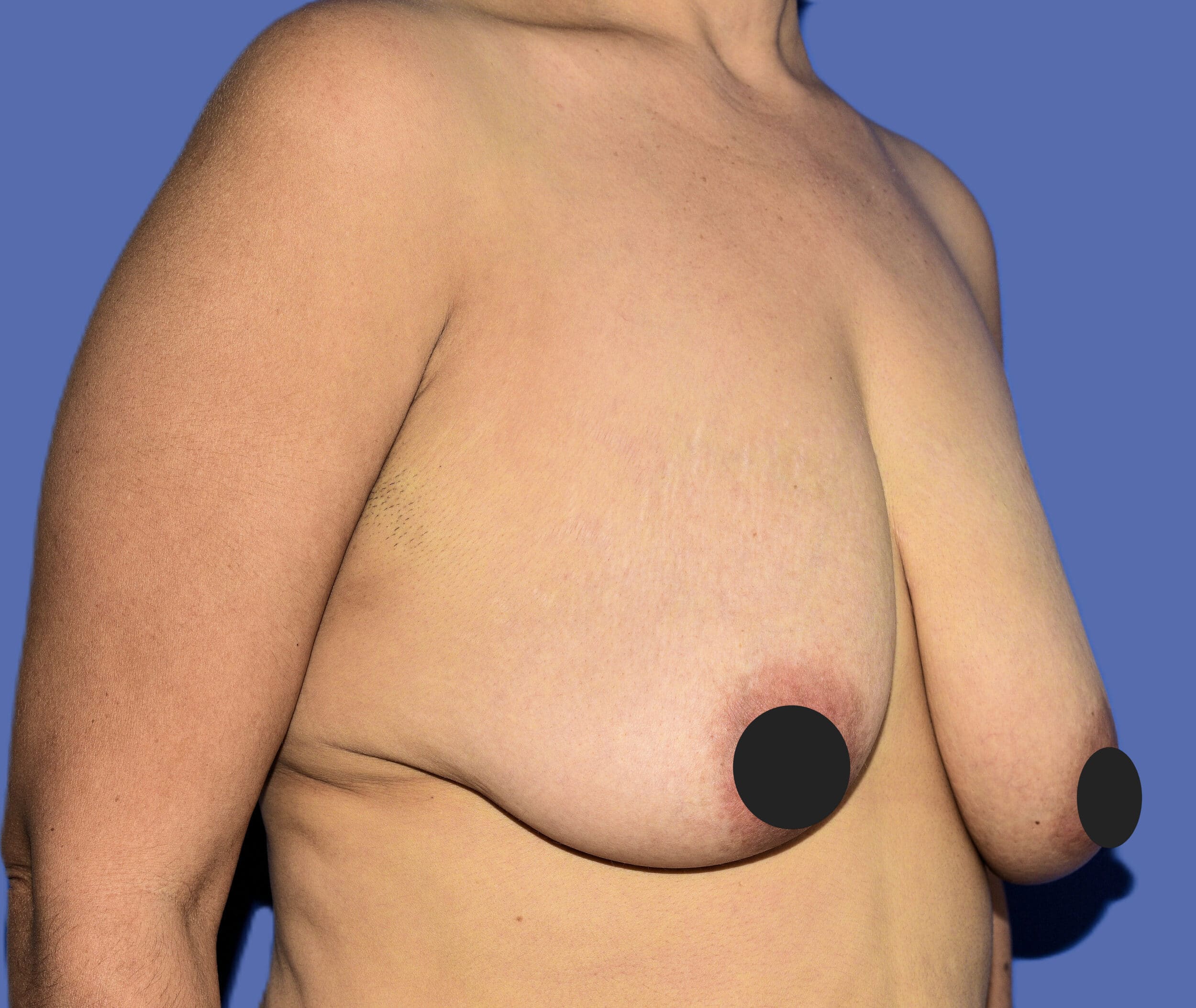Before Image: Breast Lift (Mastopexy) - right-front-oblique