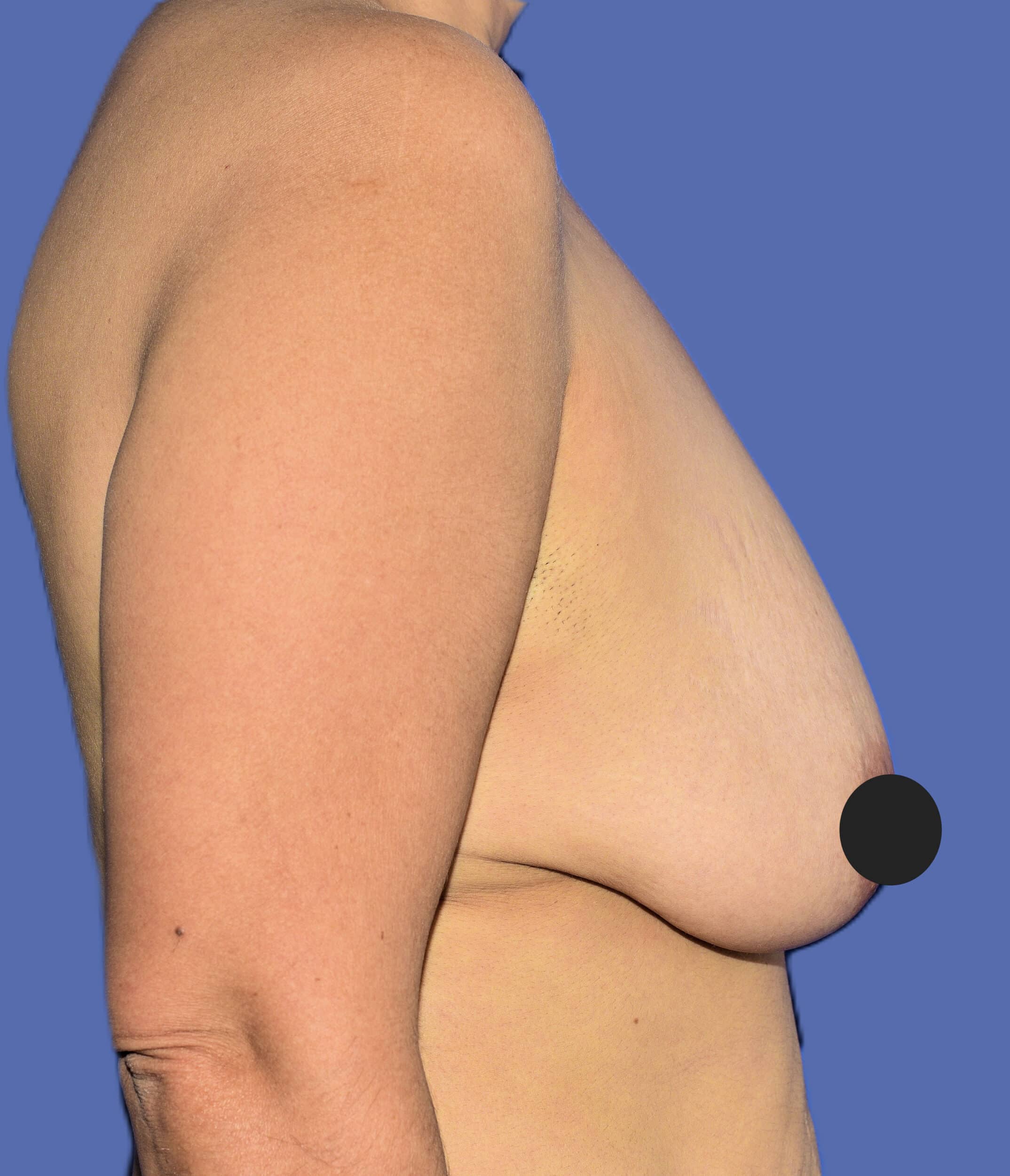 Before Image: Breast Lift (Mastopexy) - right-side