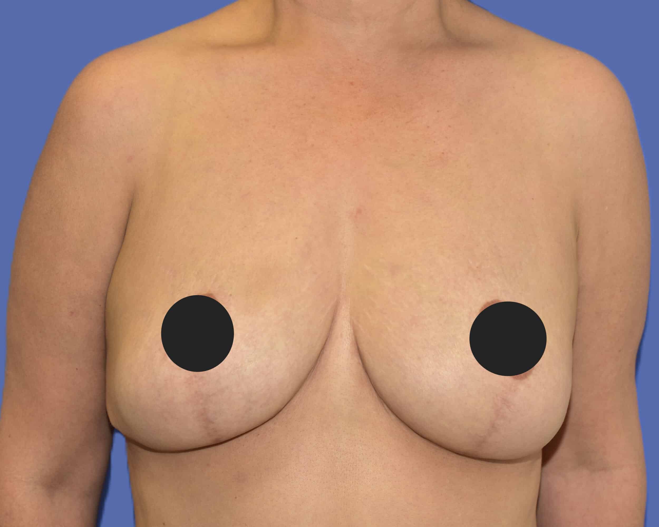 After Image: Breast Lift (Mastopexy) - front
