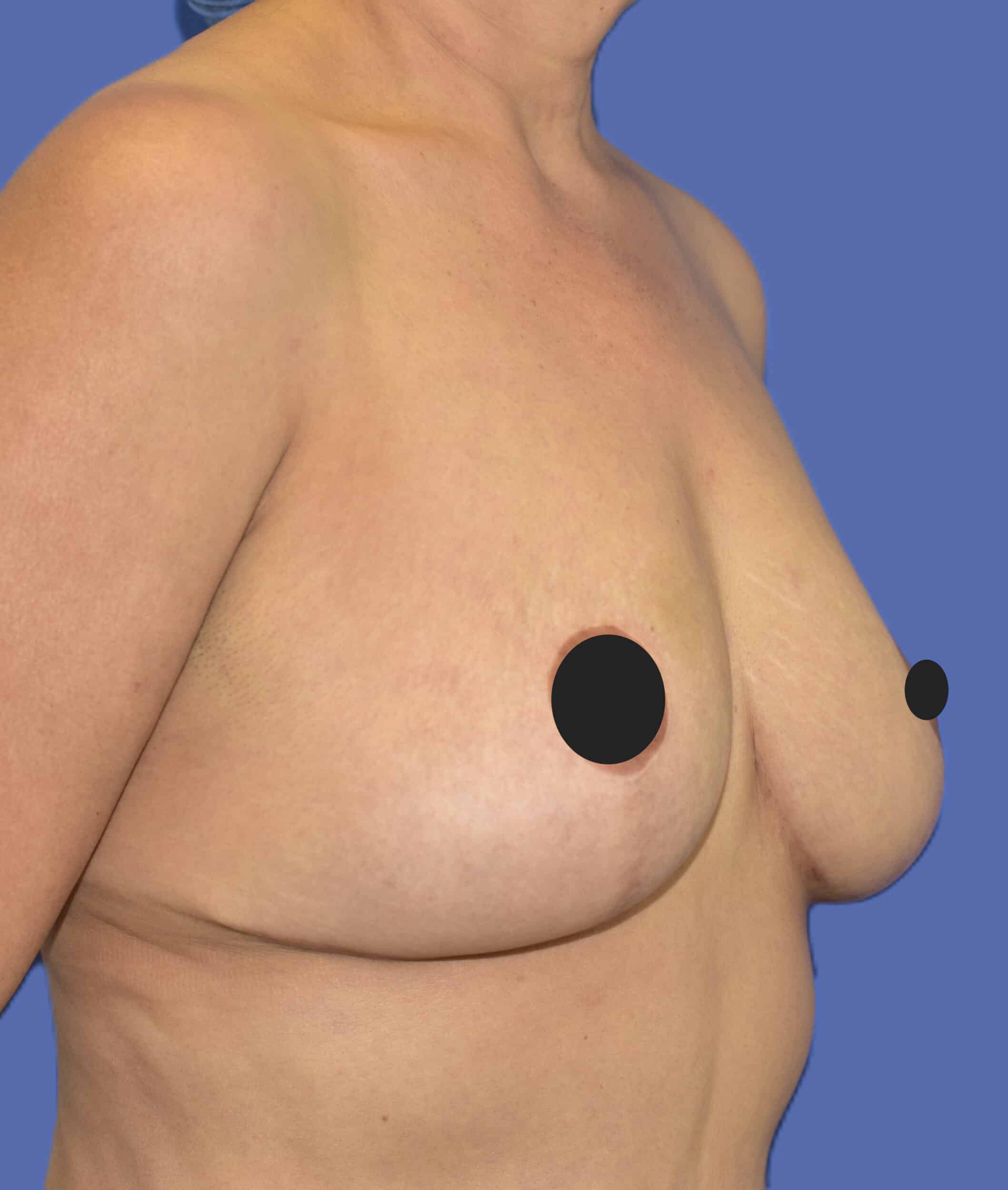 After Image: Breast Lift (Mastopexy) - right-front-oblique