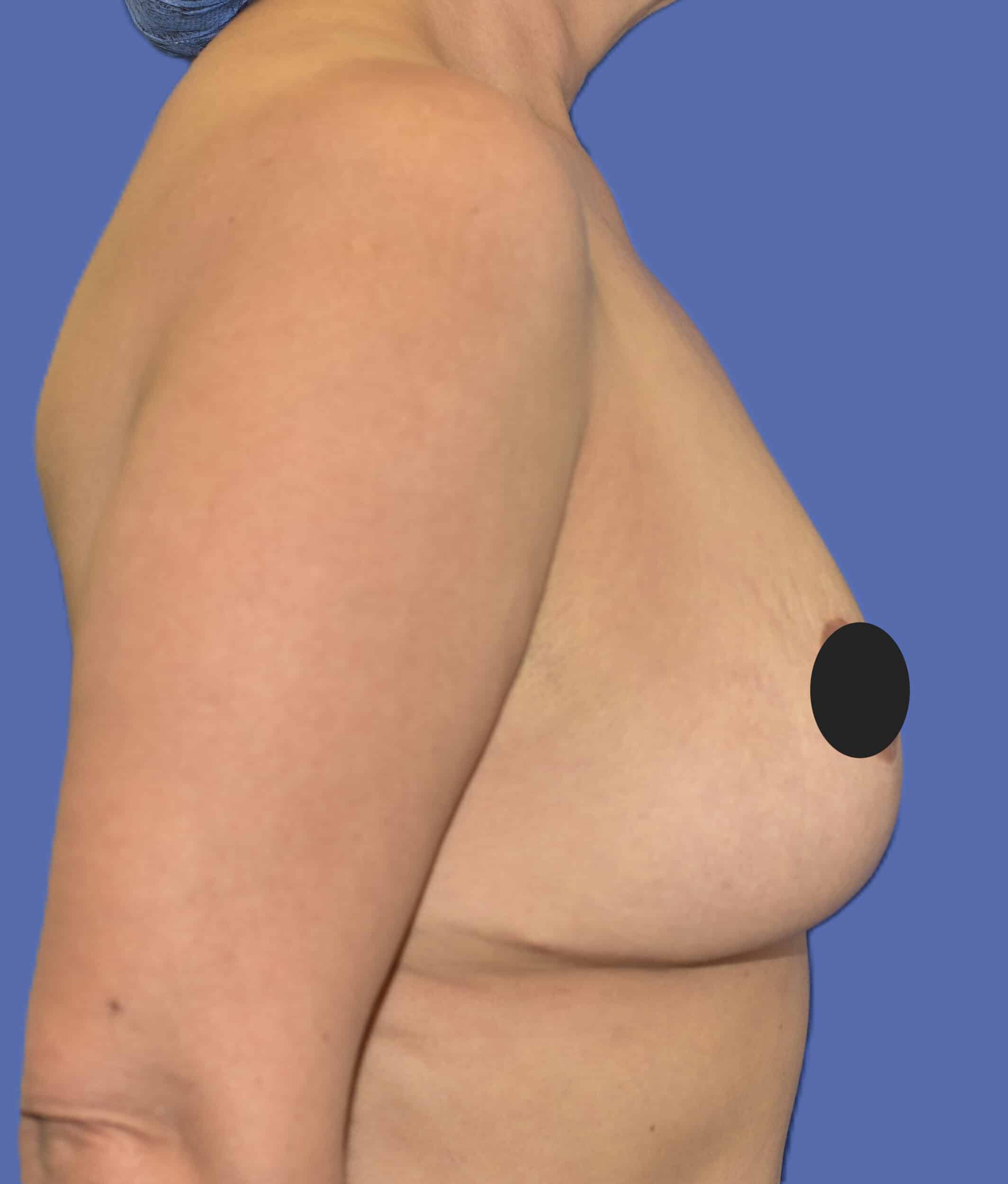 After Image: Breast Lift (Mastopexy) - right-side