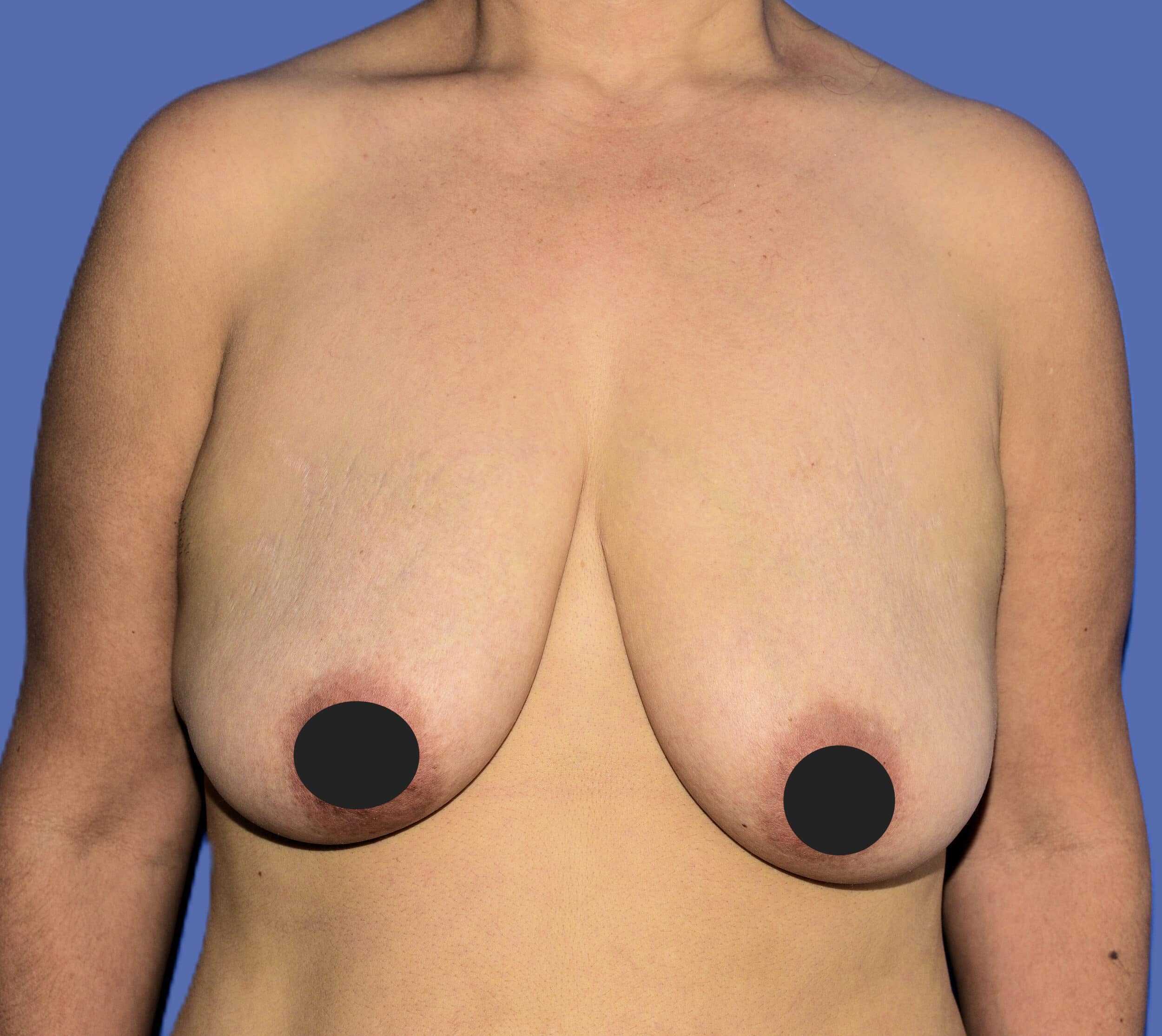 Before Image: Breast Lift (Mastopexy) - front
