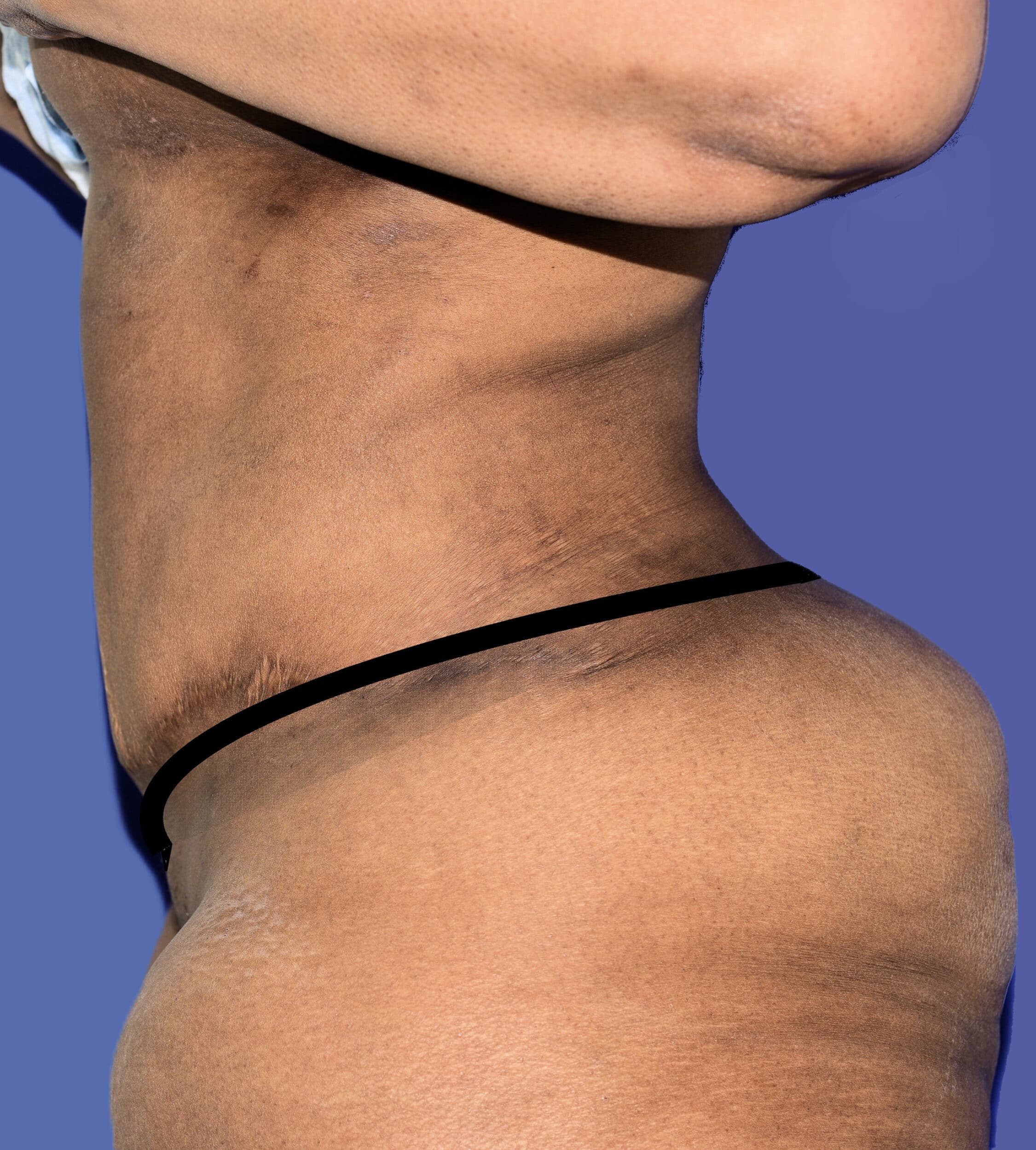 After Image: Tummy Tuck - left-side