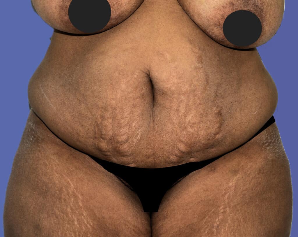 Before Image: Tummy Tuck - front