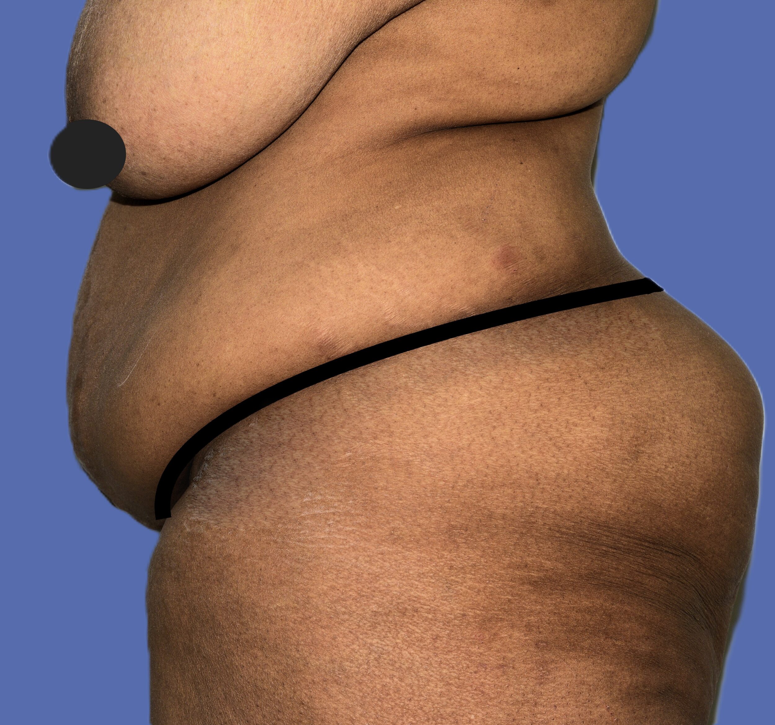 Before Image: Tummy Tuck - left-side
