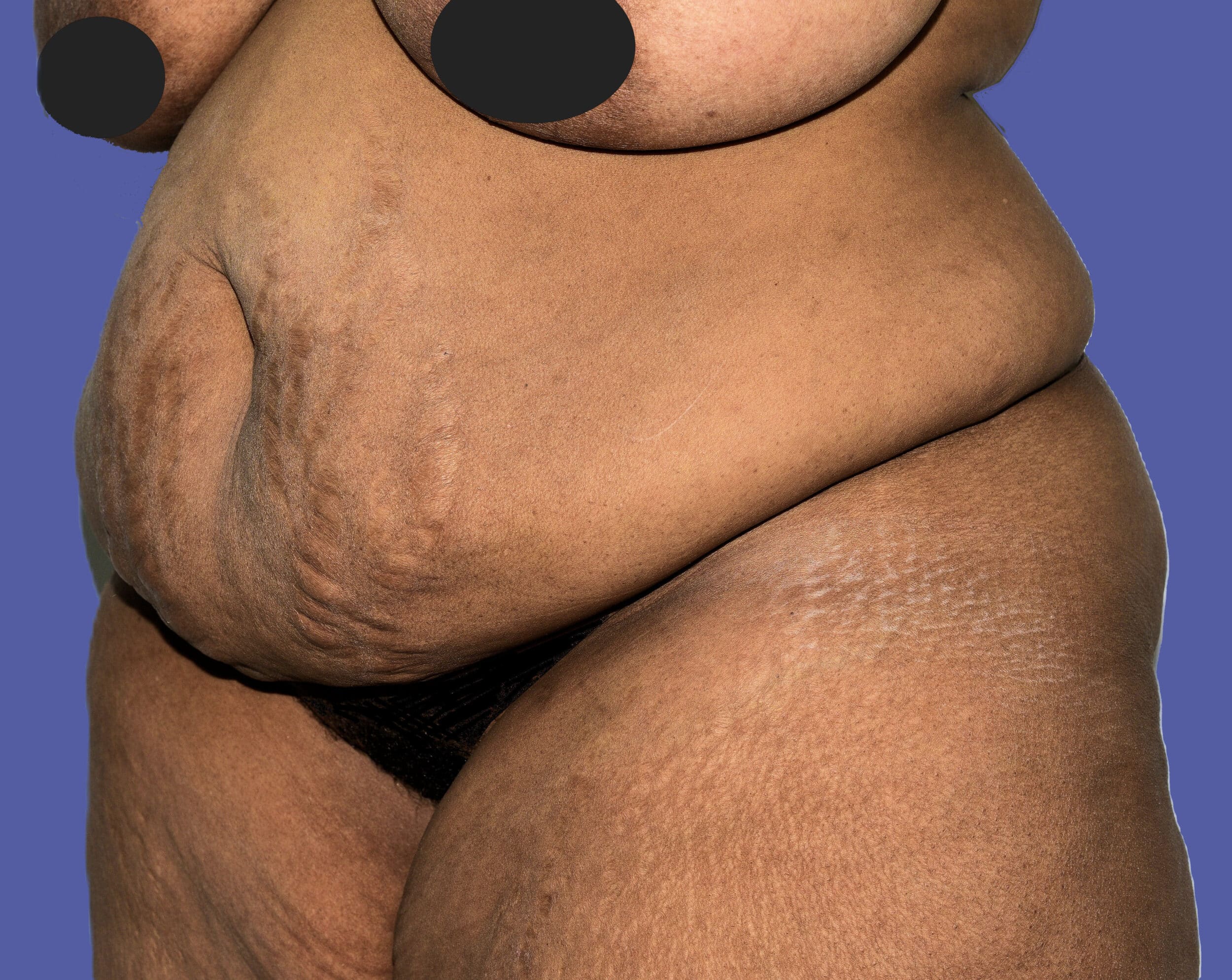 Before Image: Tummy Tuck - left-front-oblique