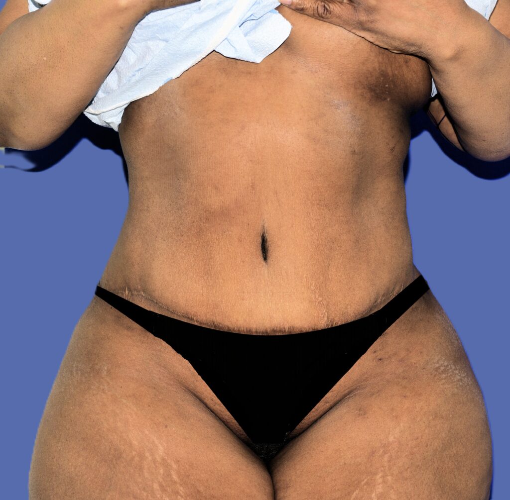 After Image: Tummy Tuck - front