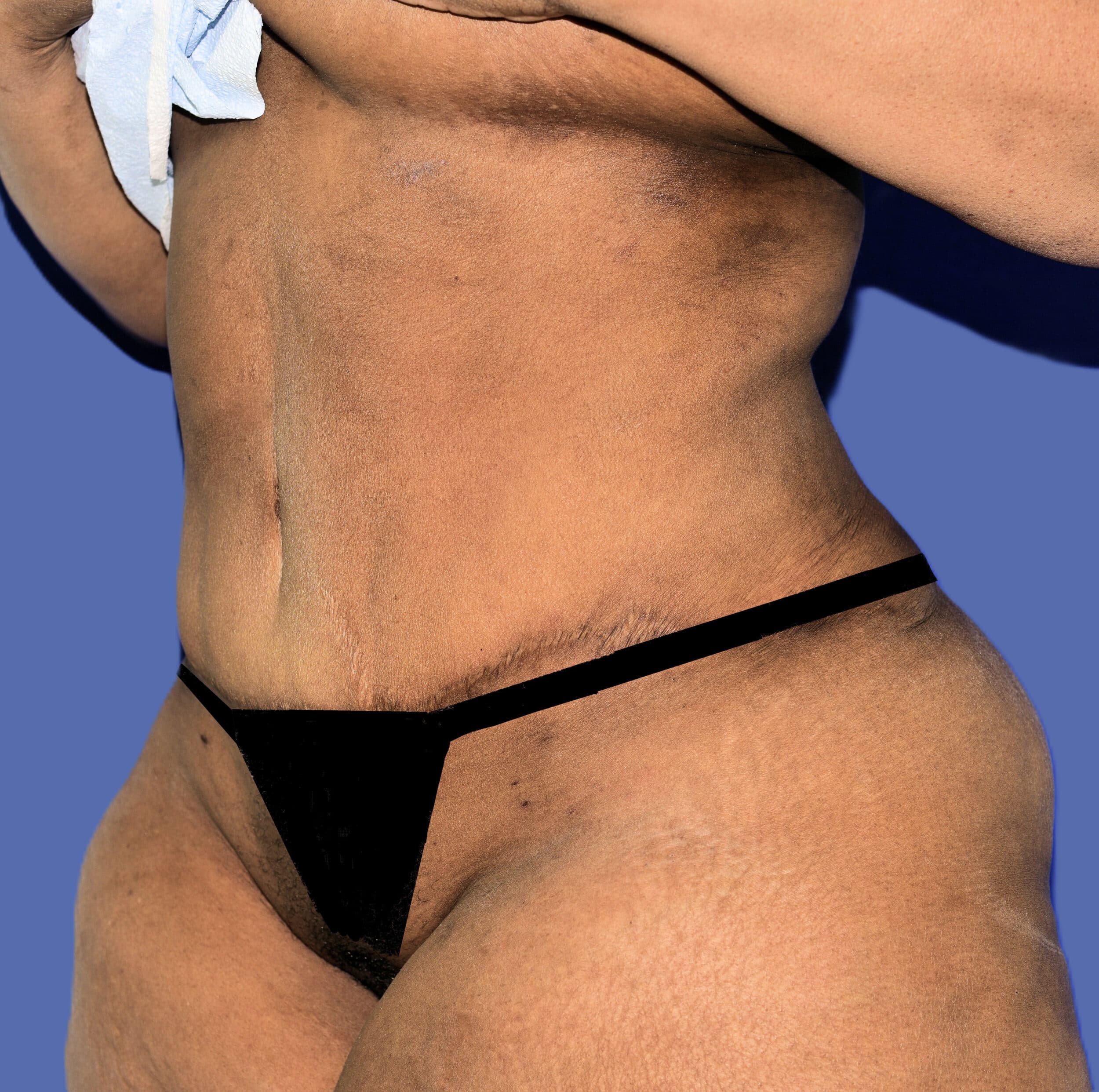 After Image: Tummy Tuck - left-front-oblique