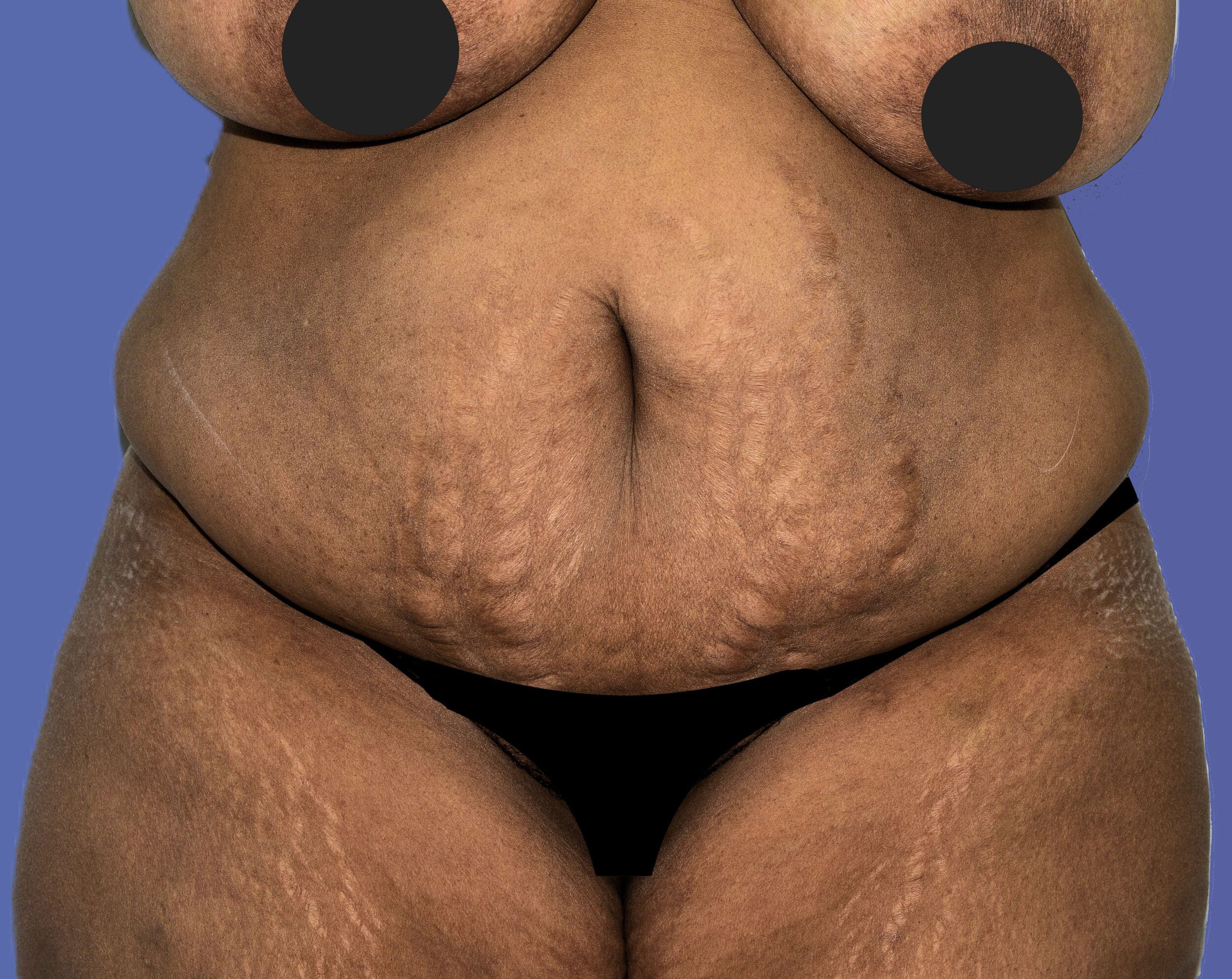 Before Image: Tummy Tuck - front