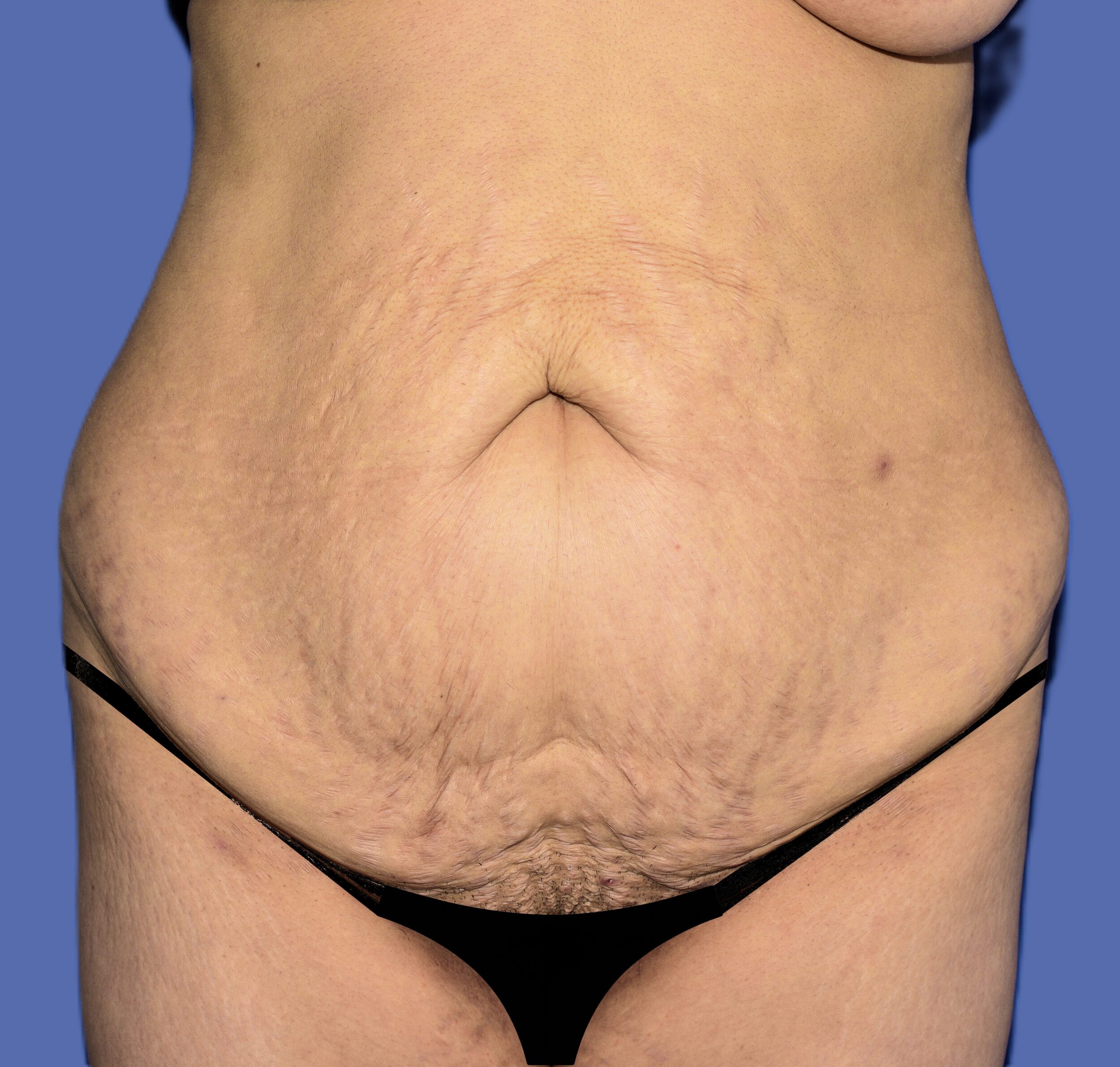 Before Image: Tummy Tuck - front