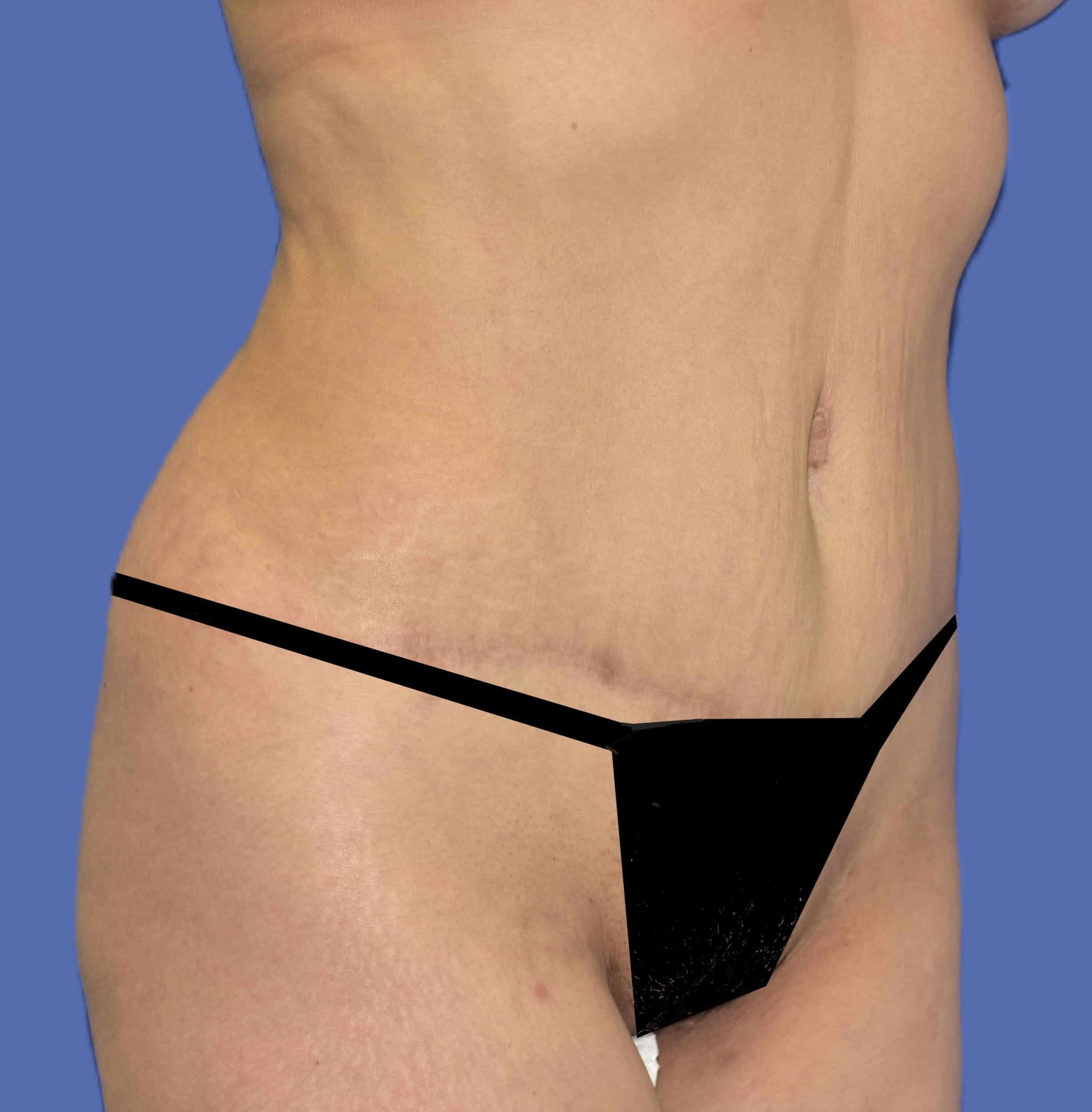 After Image: Tummy Tuck - right-front-oblique