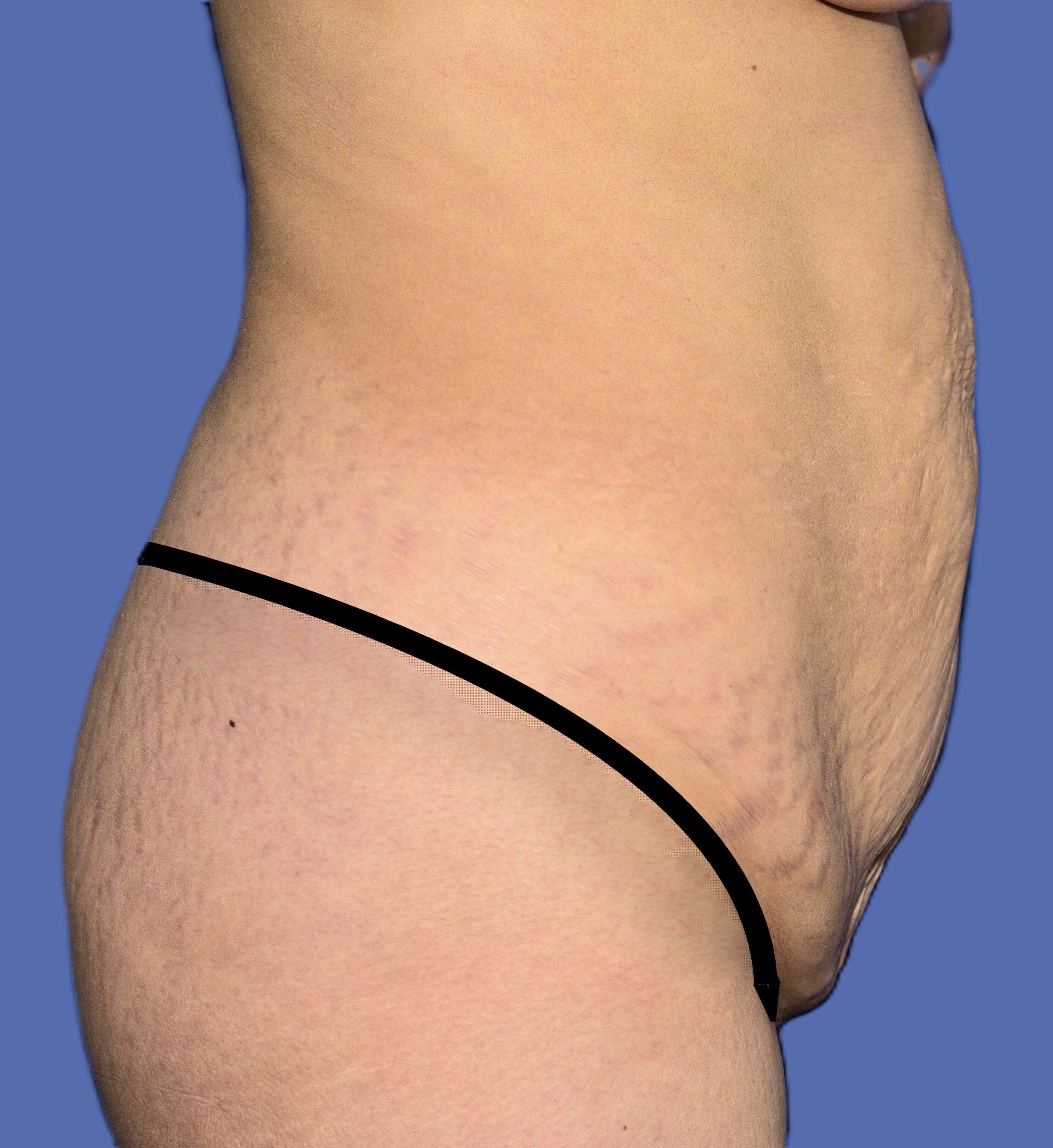 Before Image: Tummy Tuck - right-side