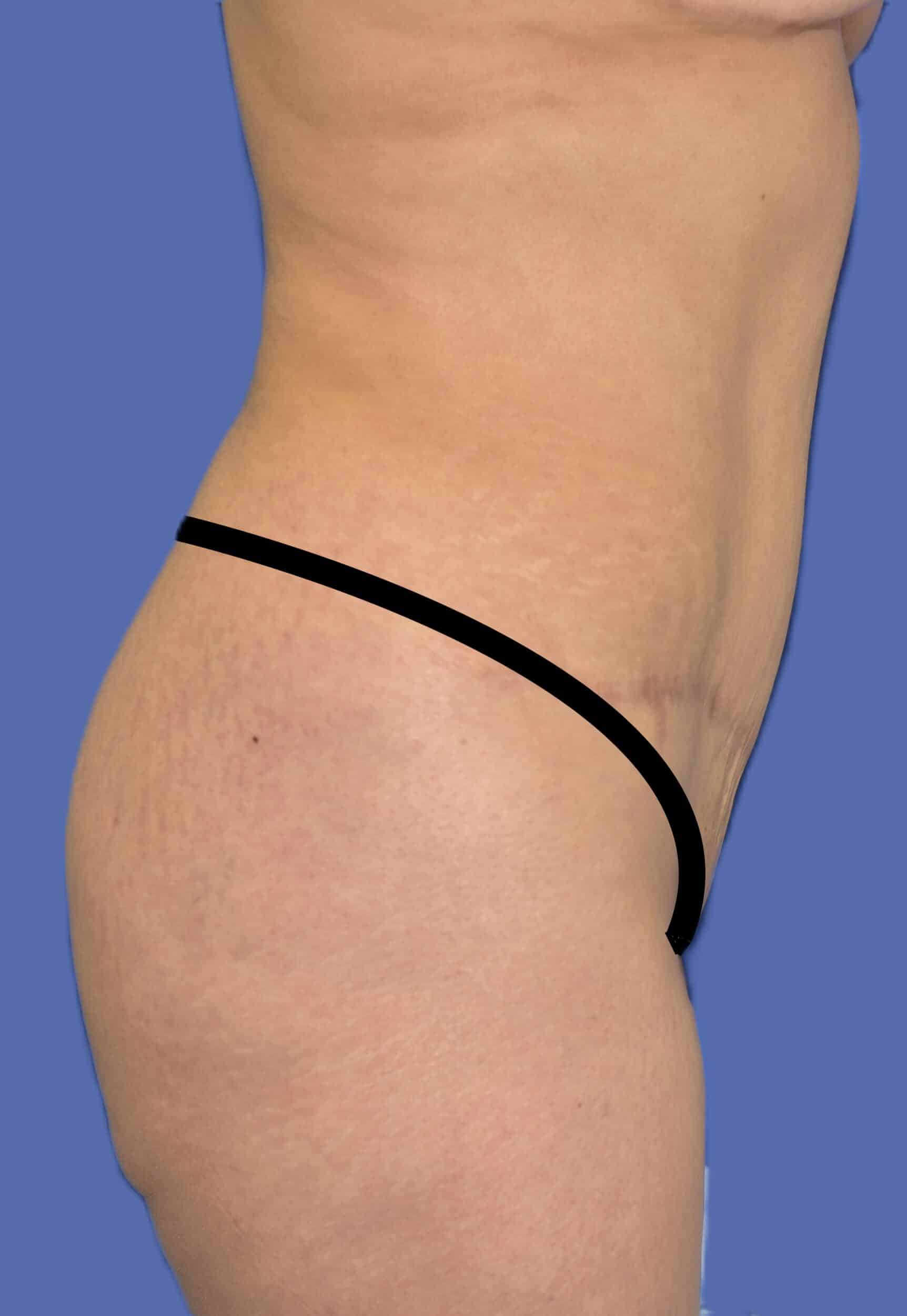 After Image: Tummy Tuck - right-side