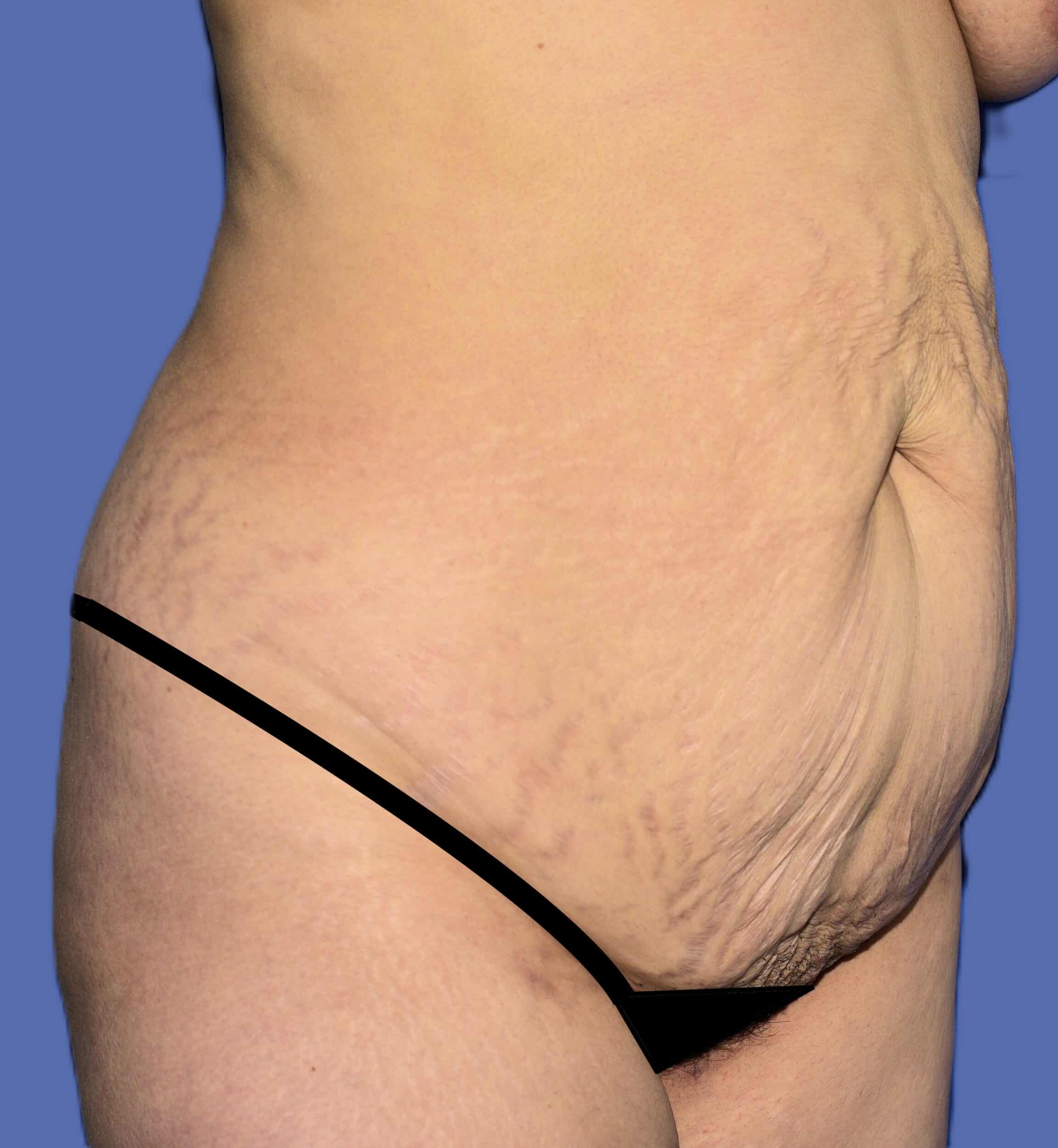 Before Image: Tummy Tuck - right-front-oblique