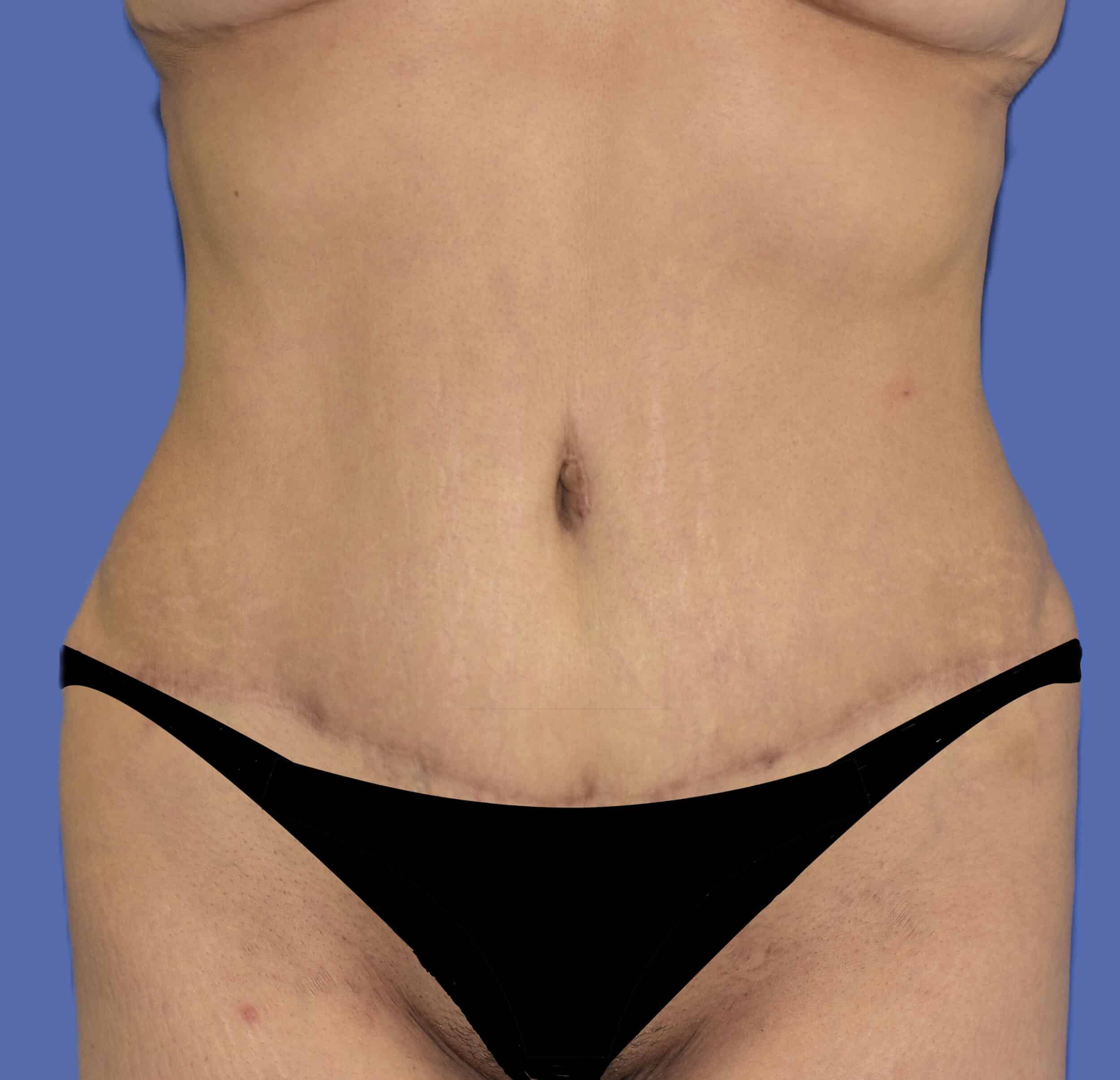 After Image: Tummy Tuck - front