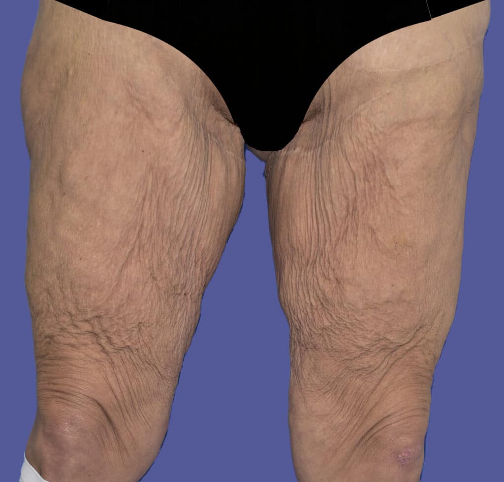 Before Image: Thigh Lift - front