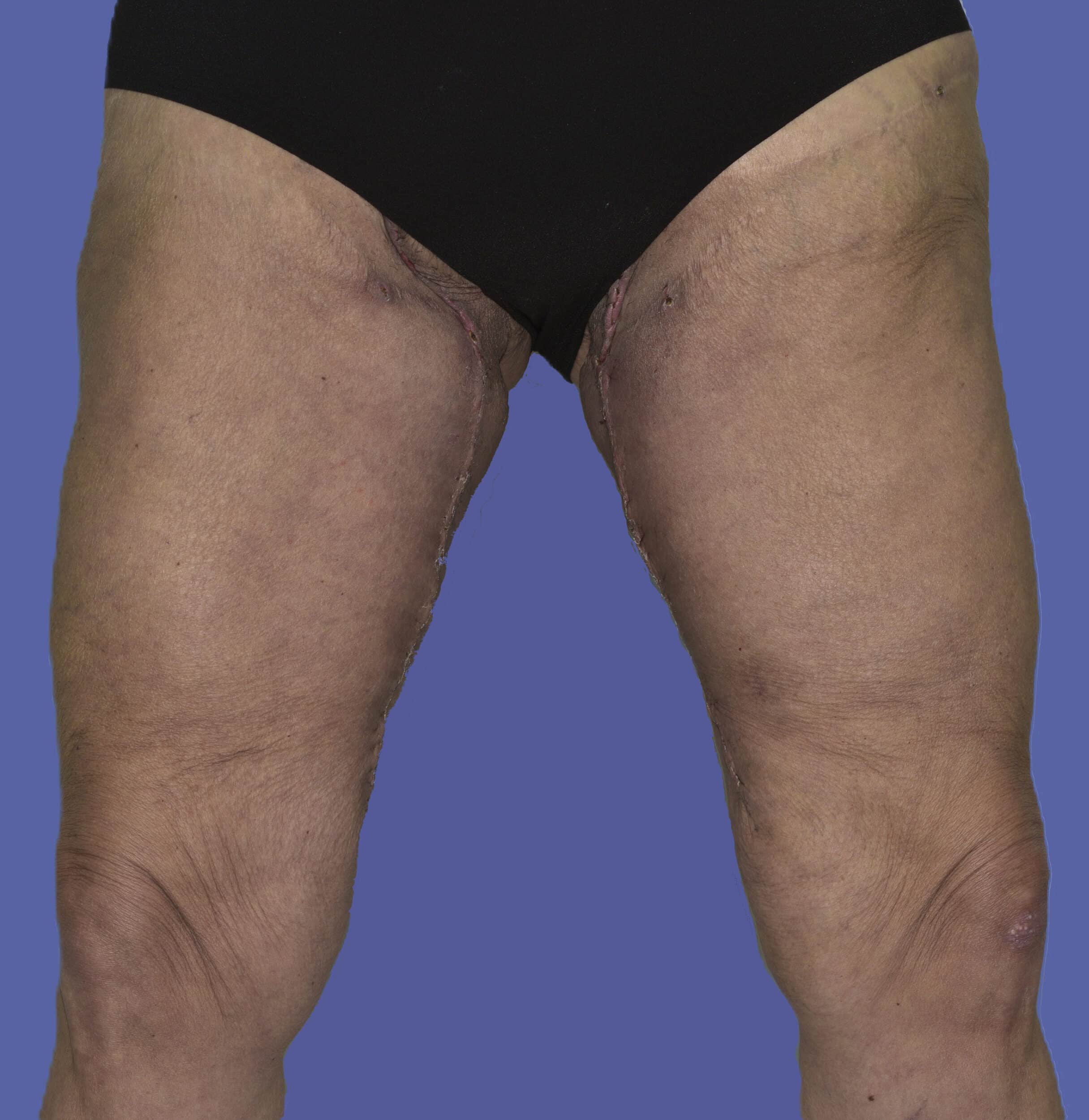After Image: Thigh Lift - front