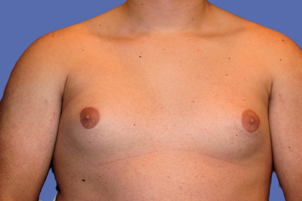 Before Image: Male Breast Reduction (Gynecomastia) - front