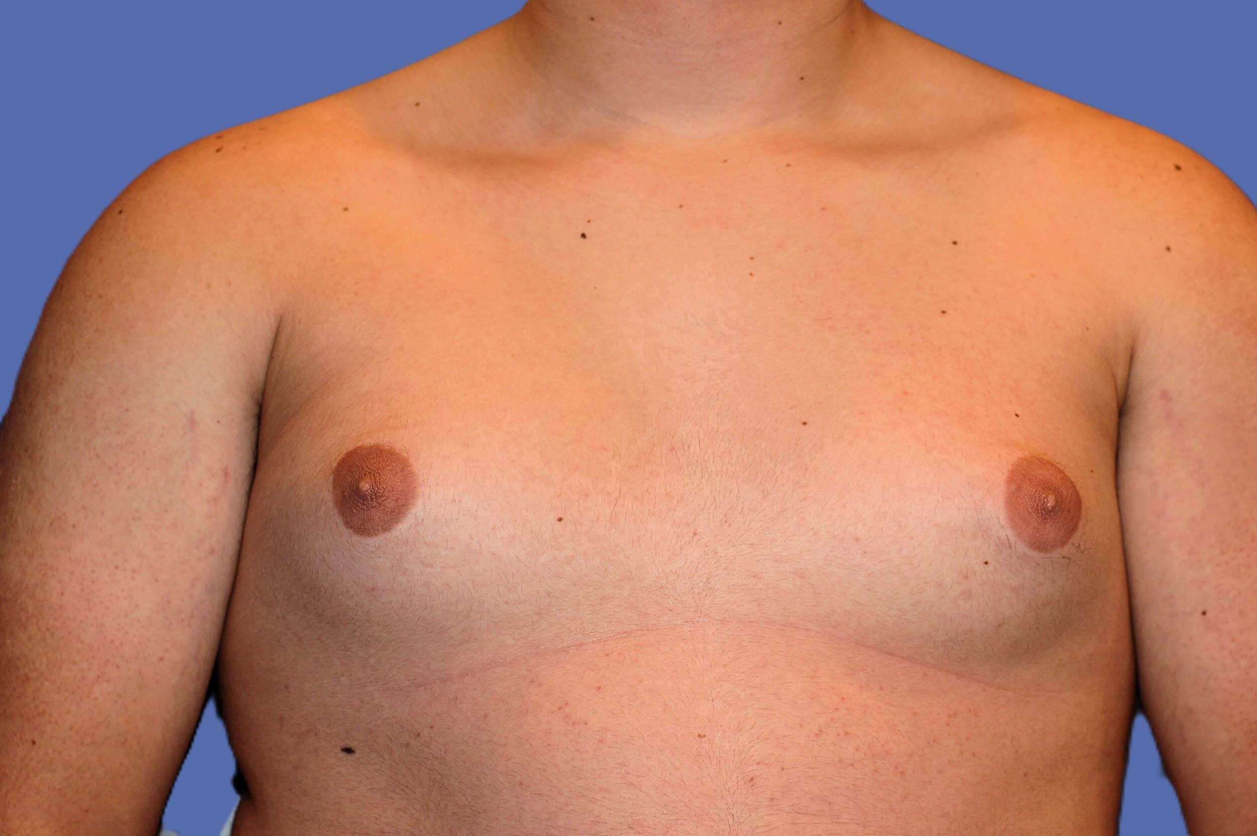Before Image: Male Breast Reduction (Gynecomastia) - front